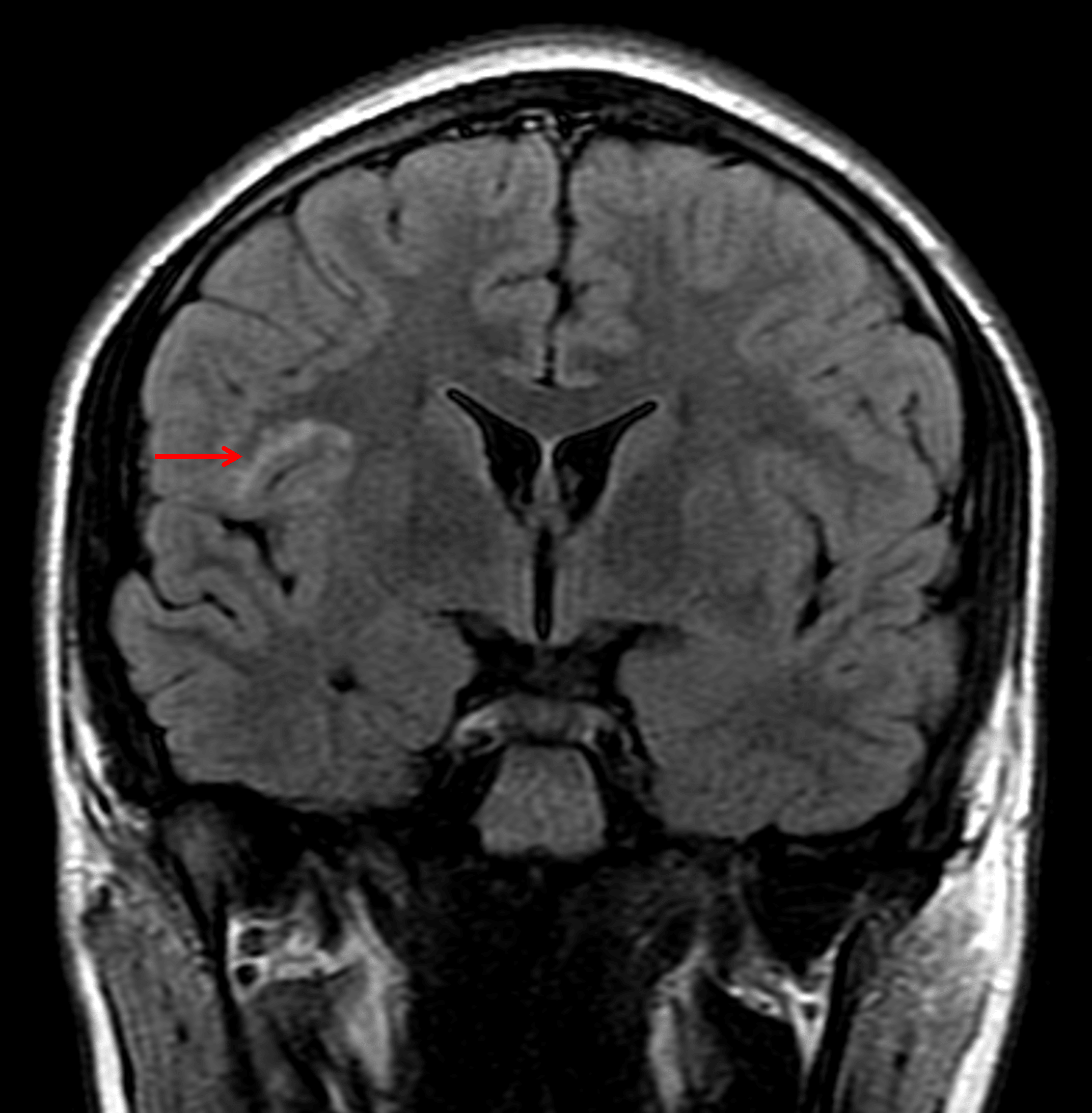 This lesion remains hyperintense on FLAIR (red arrow).