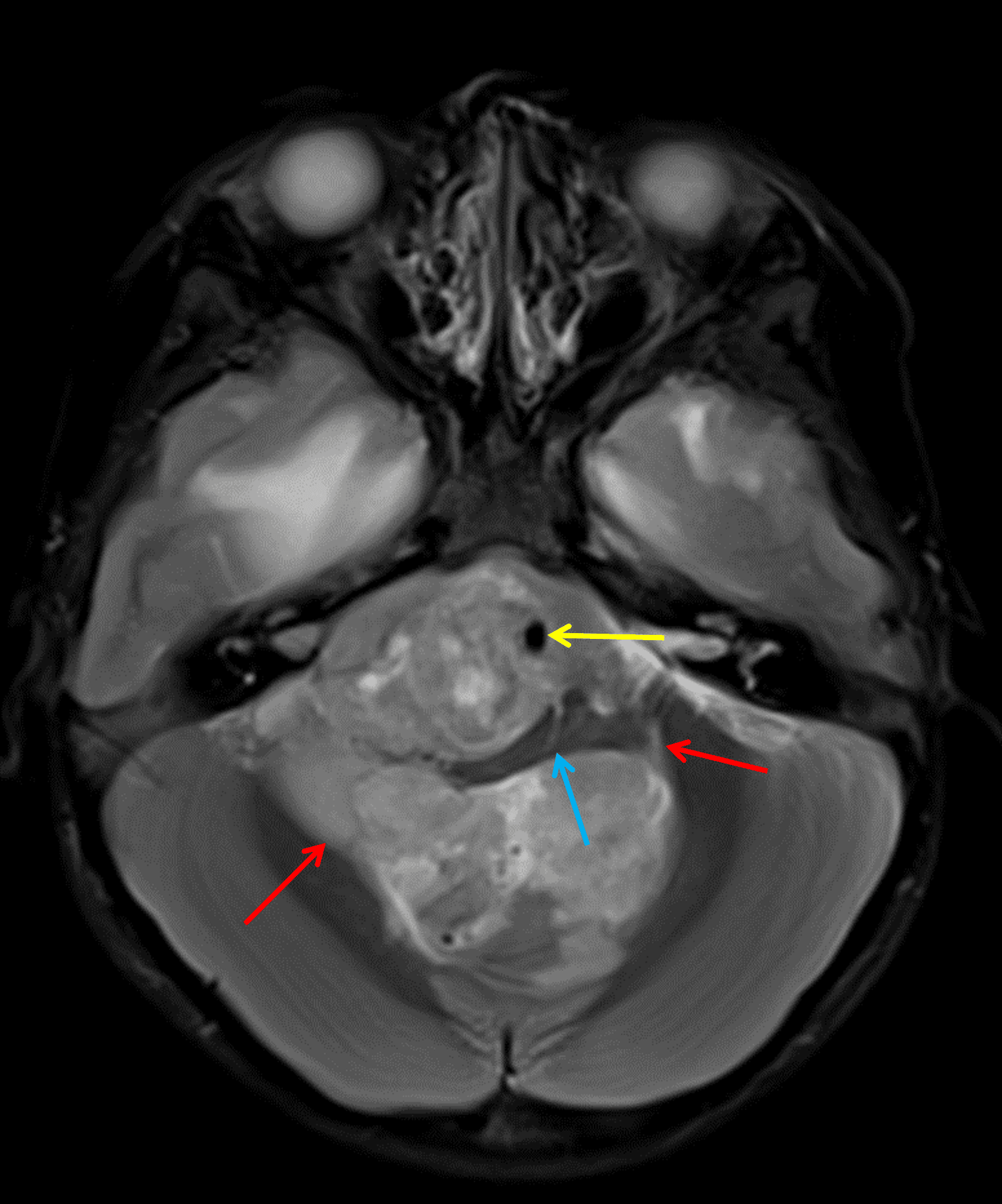 Posterior fossa ependymoma extending through the foramina of Luschka (red arrows), encasing the basilar artery (yellow arrow), and severely deforming the medulla (blue arrow).
