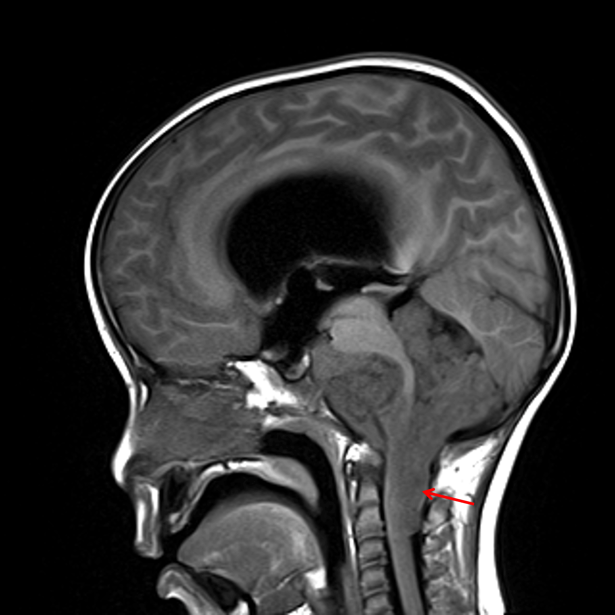 Sagittal T1 precontrast image shows the tumor encasing multiple posterior fossa structures and extending inferiorly within the dorsal aspect of the upper cervical spinal canal (red arrow).