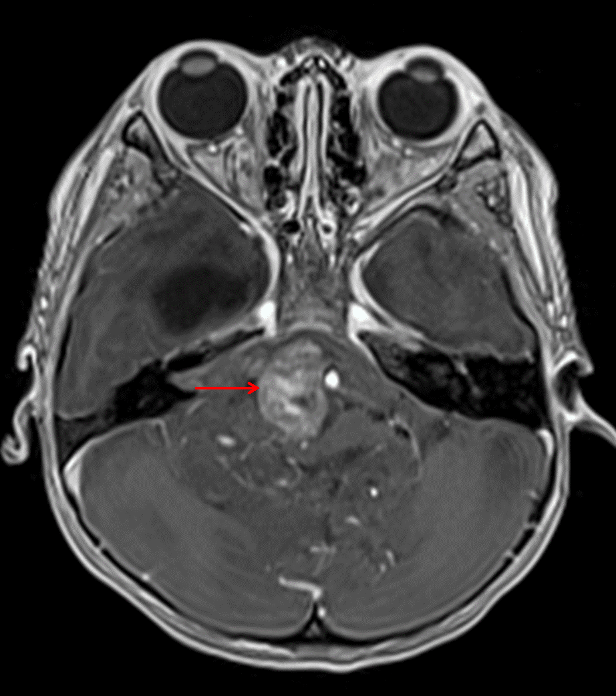 Heterogeneous areas of internal enhancement, including in the prepontine tumor component (red arrow).