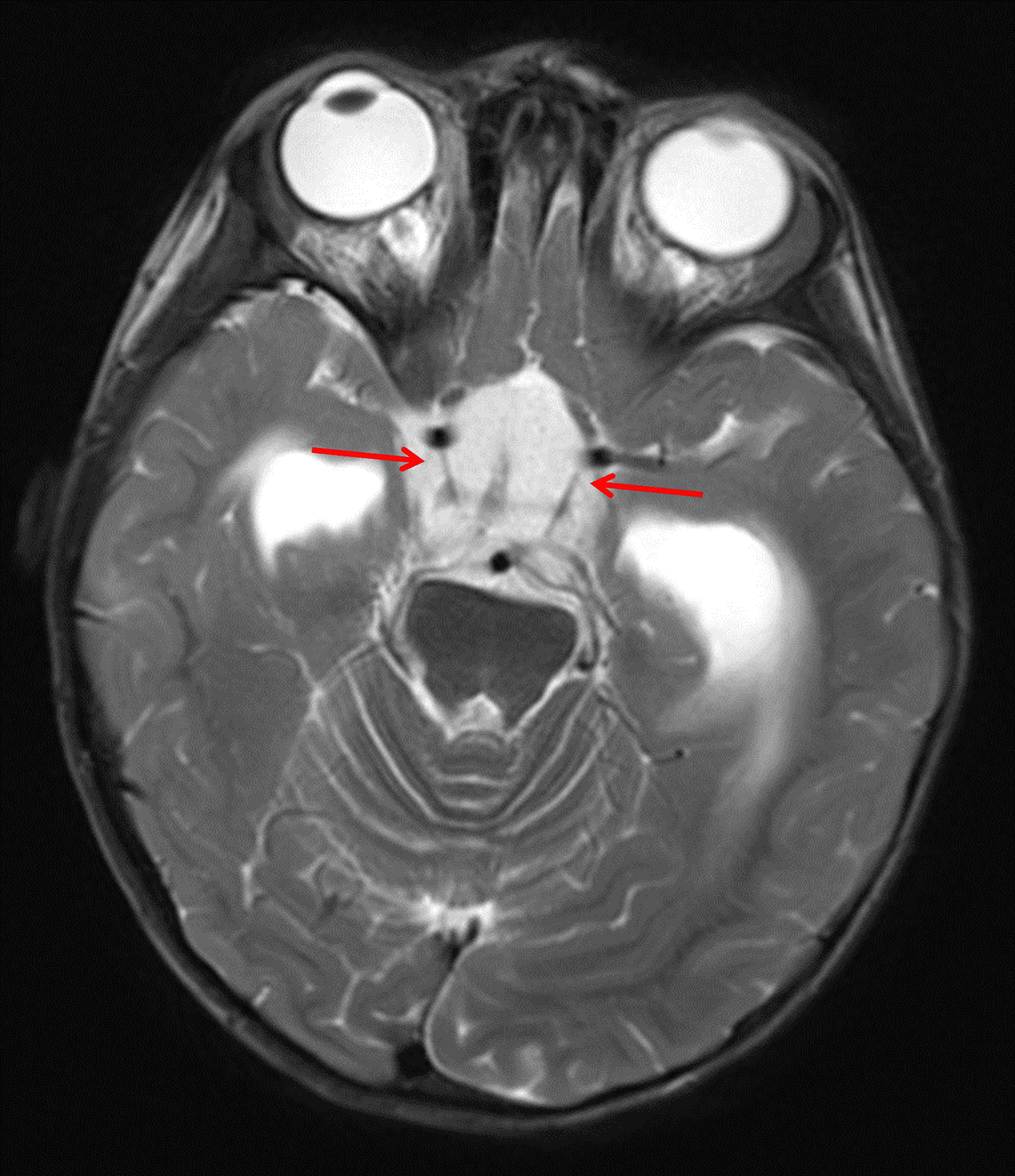 Markedly T2 hyperintense mass centered in the suprasellar cistern (red arrows).
