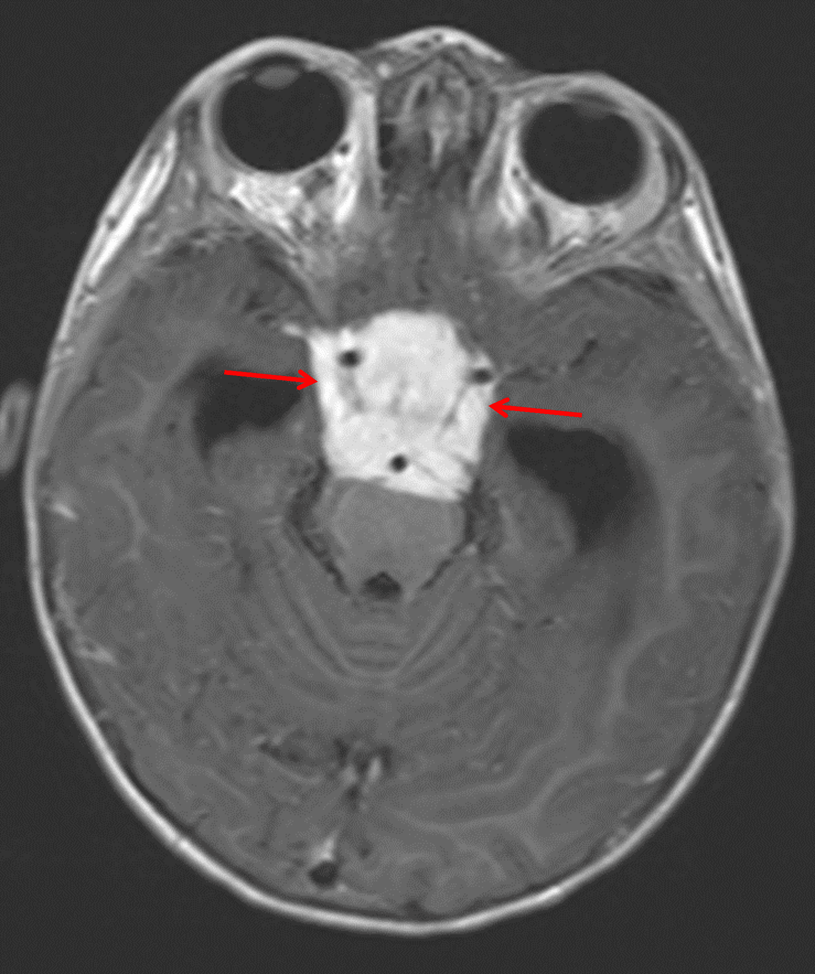 Corresponding avid enhancement (red arrows). The mass encases multiple vascular structures and extends into the prepontine cistern with mass effect on the pons.
