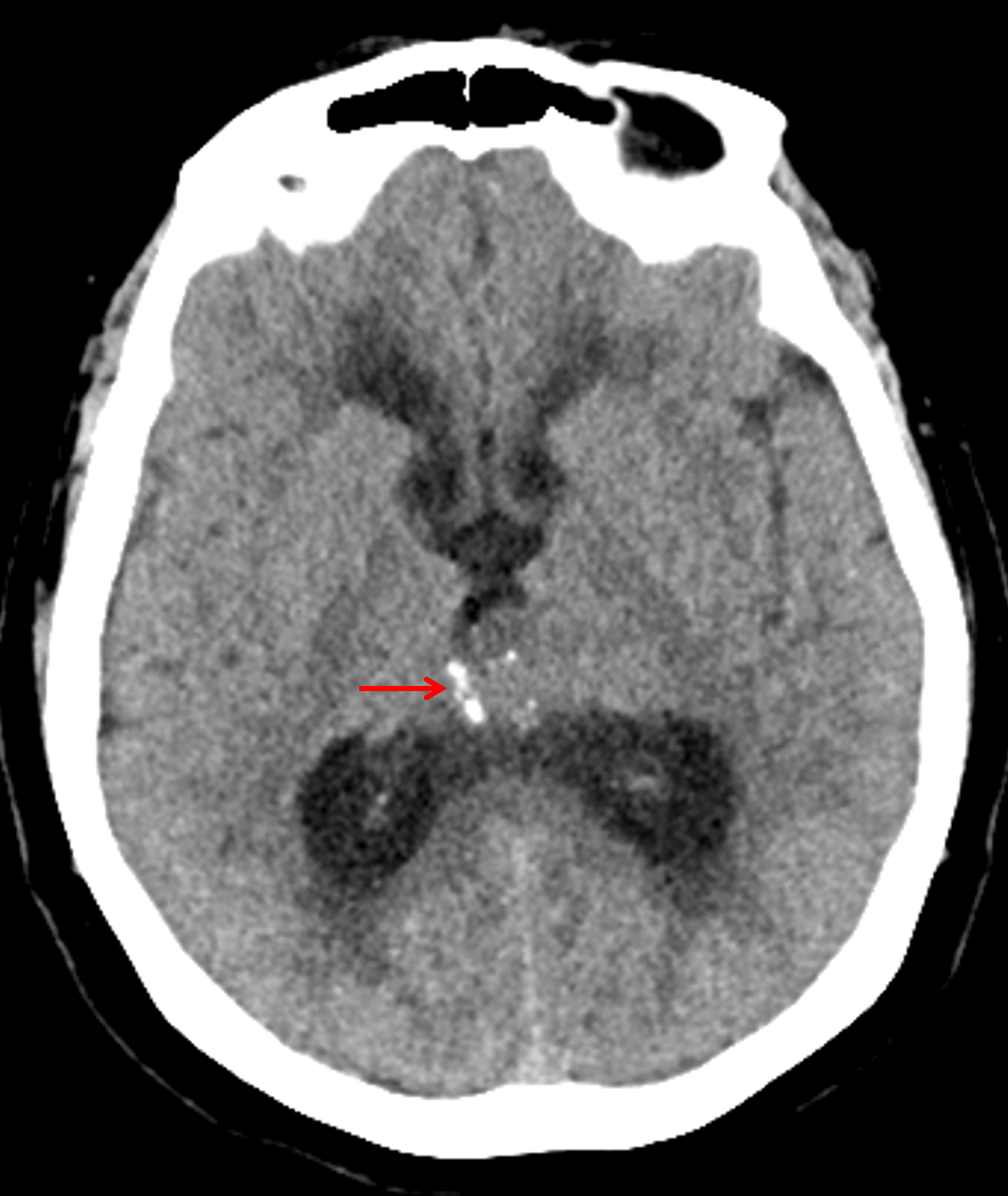 A pineal region mass with peripheral calcification (red arrow) is identified on CT.