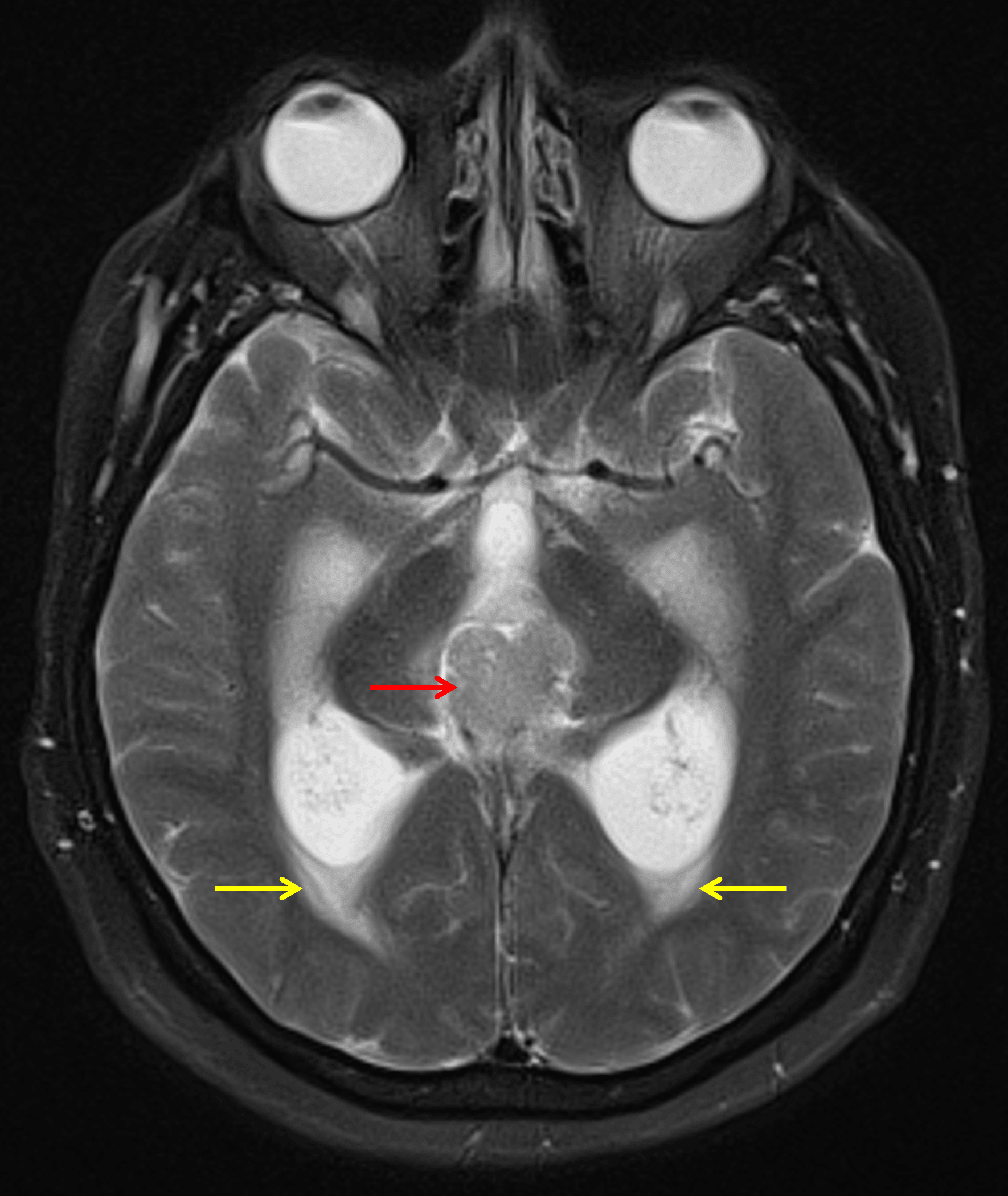 The mass demonstrates intermediate T2 signal intensity (red arrow). There is associated obstructive hydrocephalus with subependymal edema (yellow arrows).