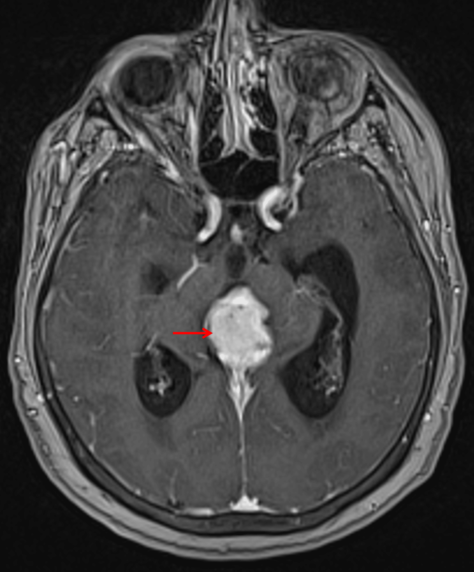 There is avid corresponding enhancement (red arrow).