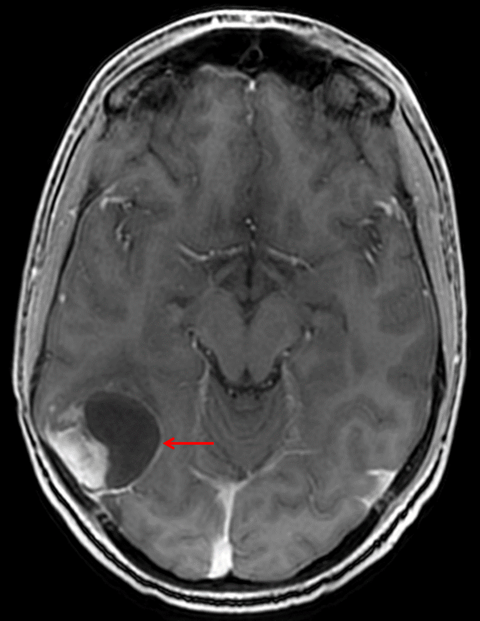Mixed solid and cystic mass centered in the posterior right temporal lobe (red arrow) with adjacent broad dural contact.