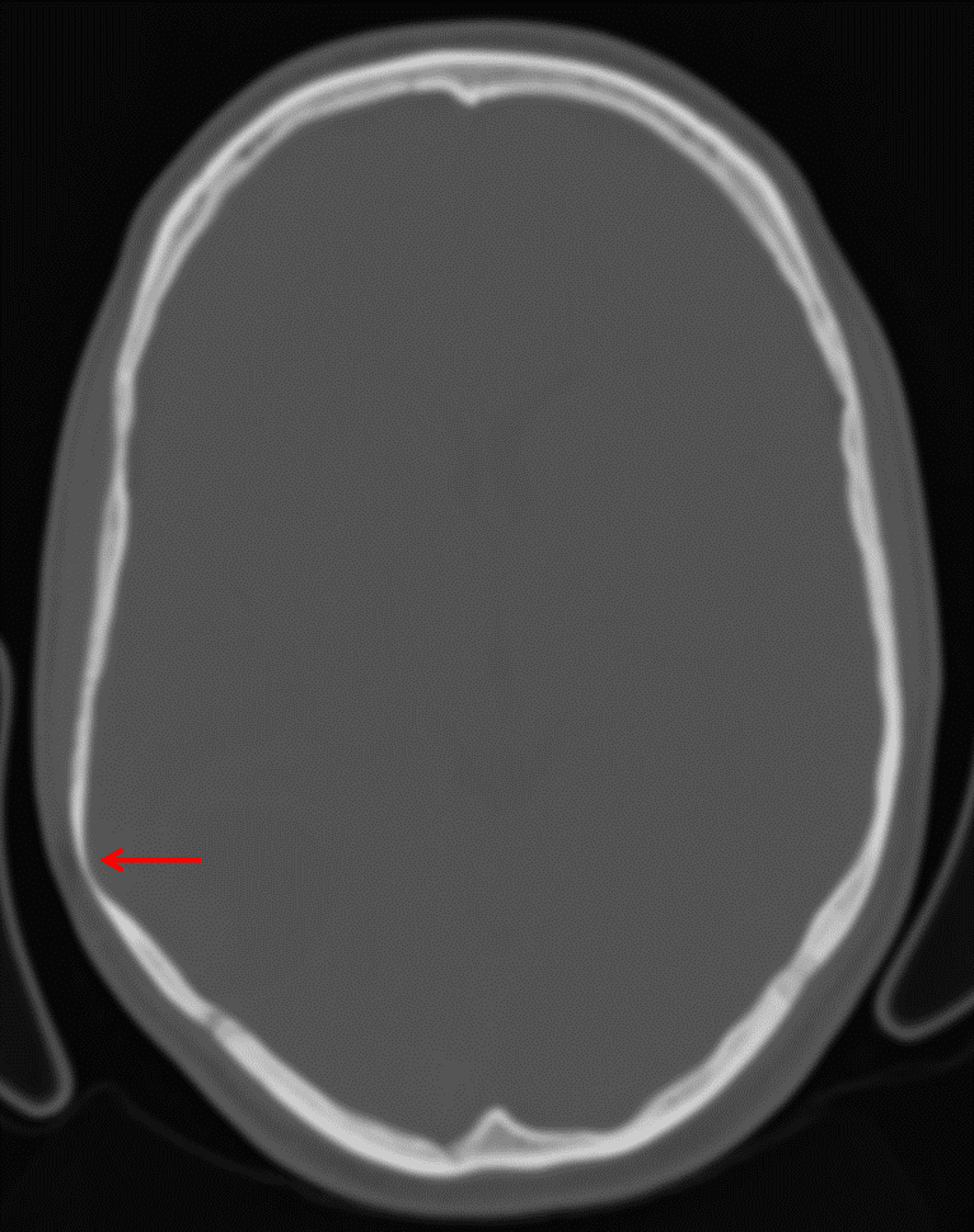 Note overlying smooth scalloping of the inner table of the calvarium (red arrow), favoring this to represent a slow-growing tumor.
