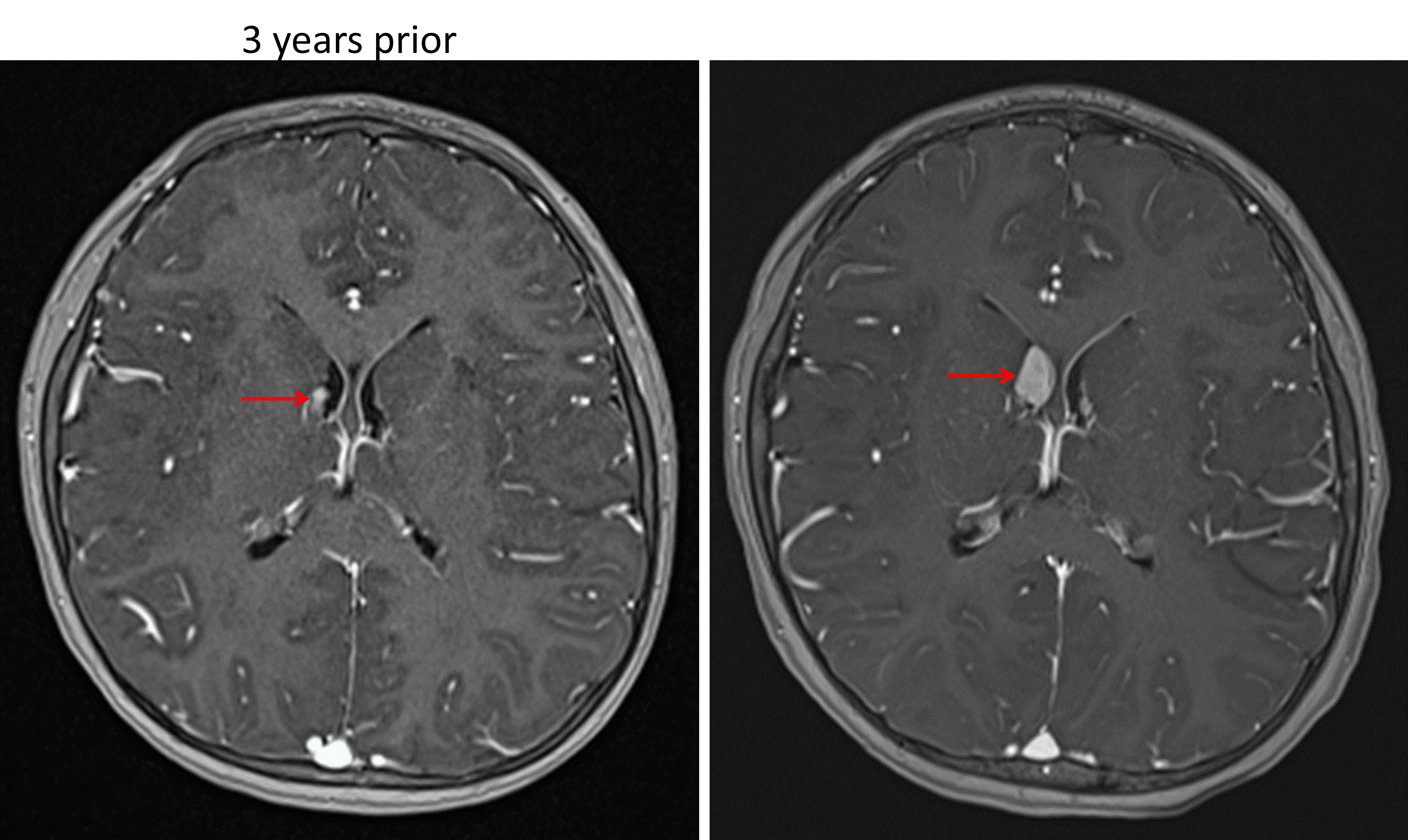 Enhancing subependymal nodule near the right foramen of Monro (red arrows) which demonstrates growth over a 3-year period, concerning for a subependymal giant cell astrocytoma in this patient with tuberous sclerosis.