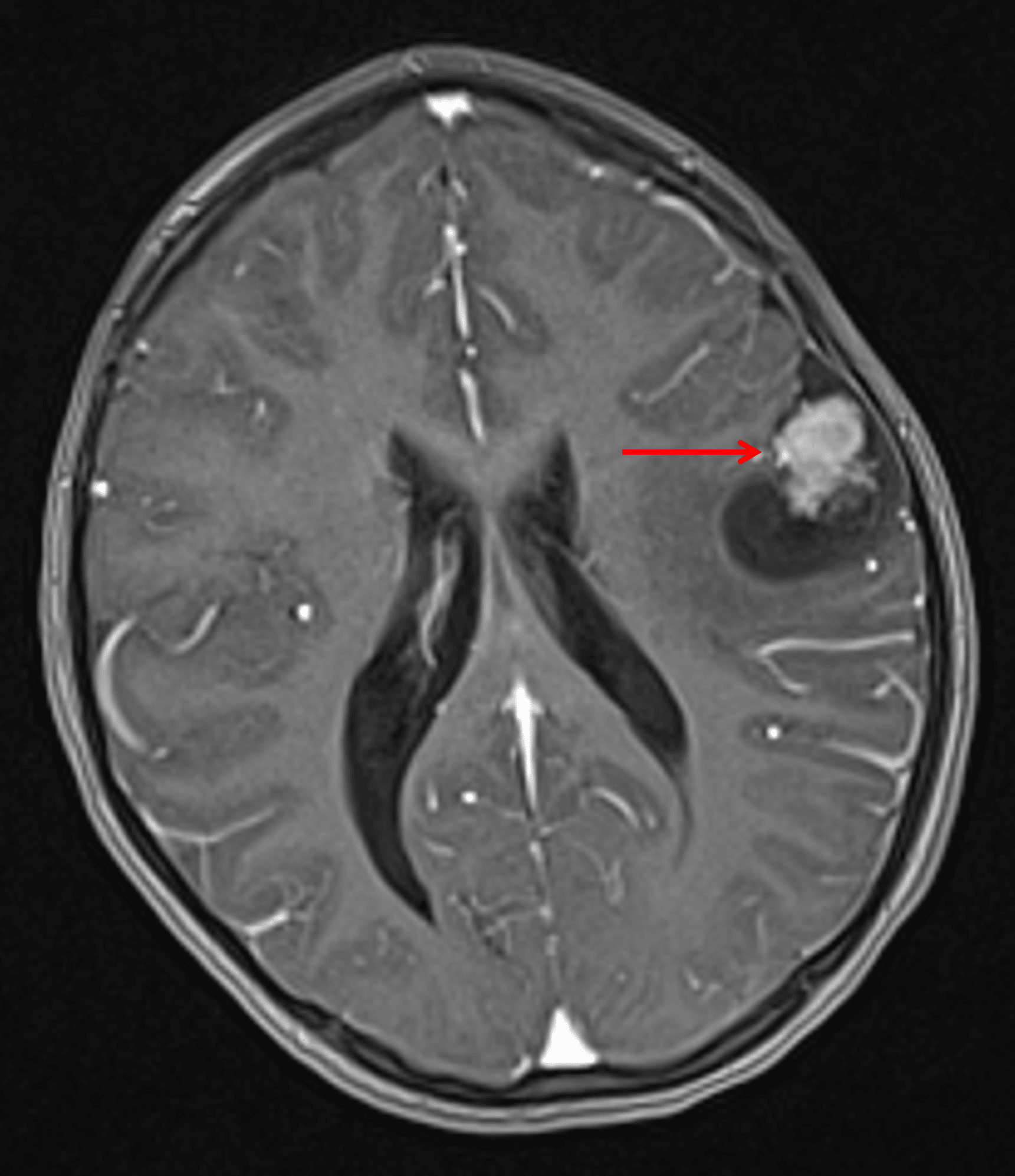 Mixed cystic and solid tumor in the inferior left frontal lobe (red arrow).