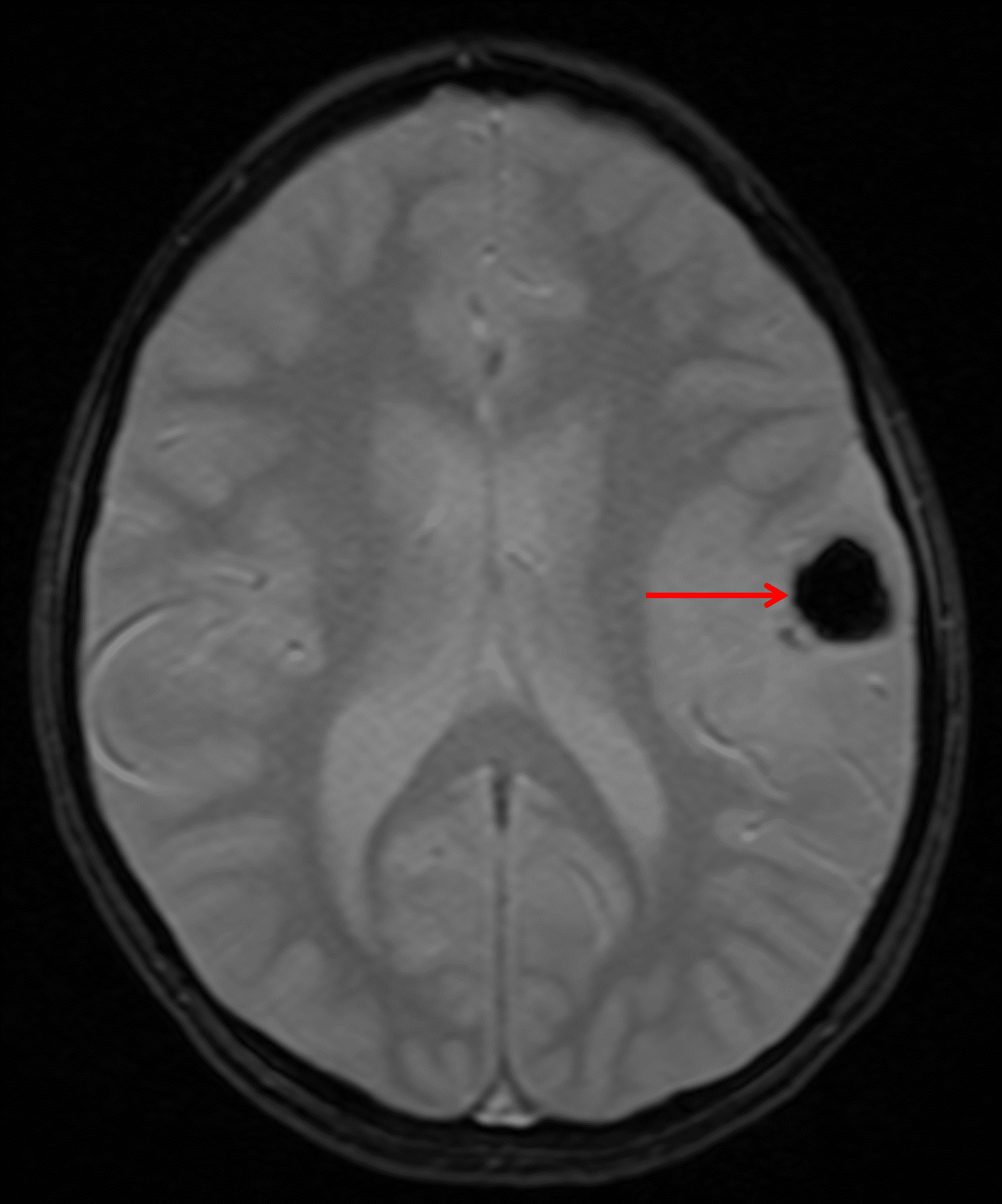Rounded area of susceptibility artifact within the tumor (red arrow) corresponding to internal calcification.