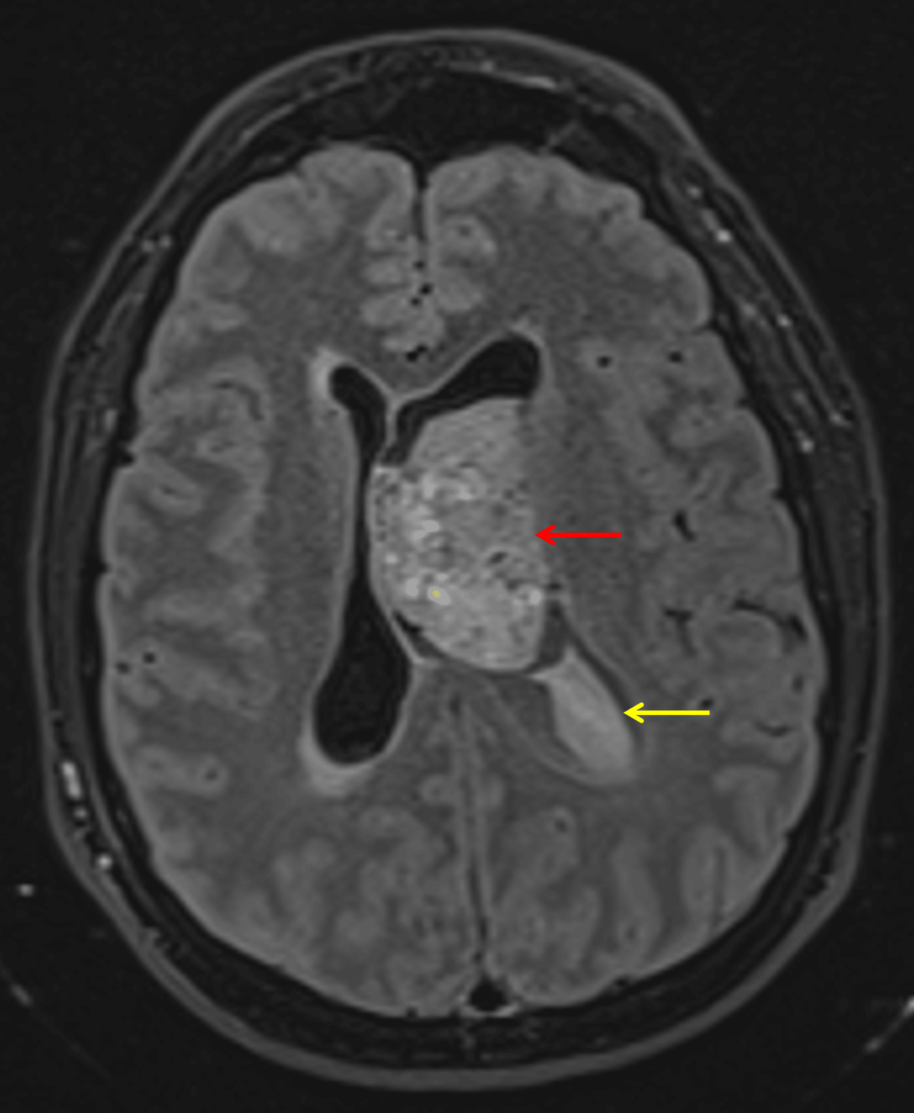 Mildly FLAIR hyperintense mass in the left lateral ventricle abutting the septum pellucidum (red arrow). Hyperintense material layering in the left lateral ventricle likely representing hemorrhage (yellow arrow).