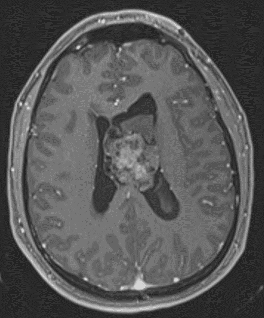 Corresponding heterogeneous enhancement.