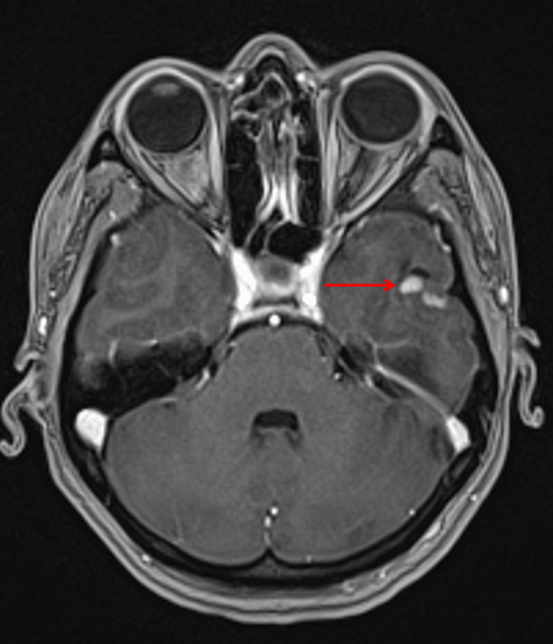 Small, mixed cystic and solid lesion in the inferior left temporal lobe with avid enhancement of the solid components (red arrow).