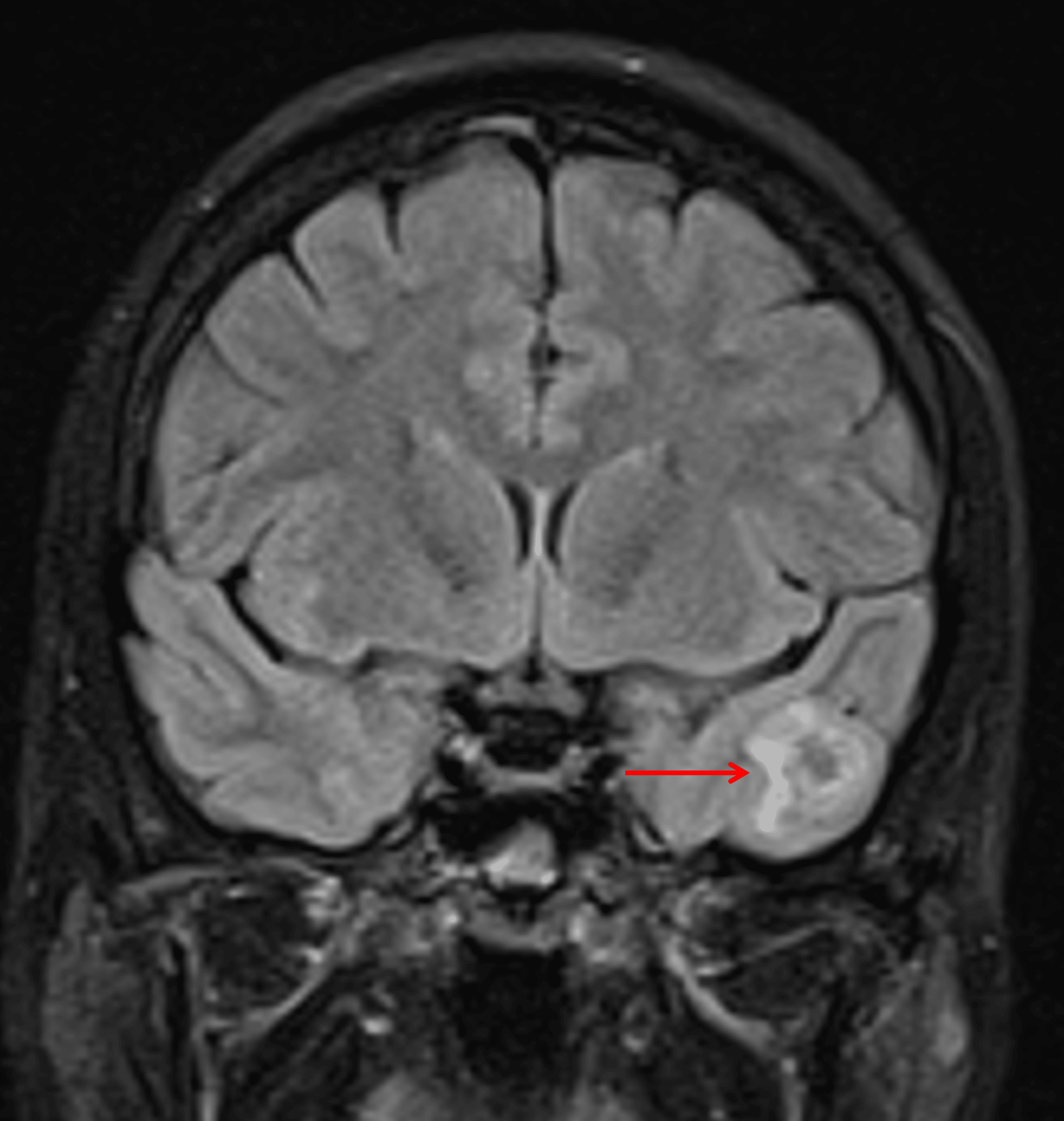 Minimal surrounding edema and mass effect (red arrow), which is typical for gangliogliomas.