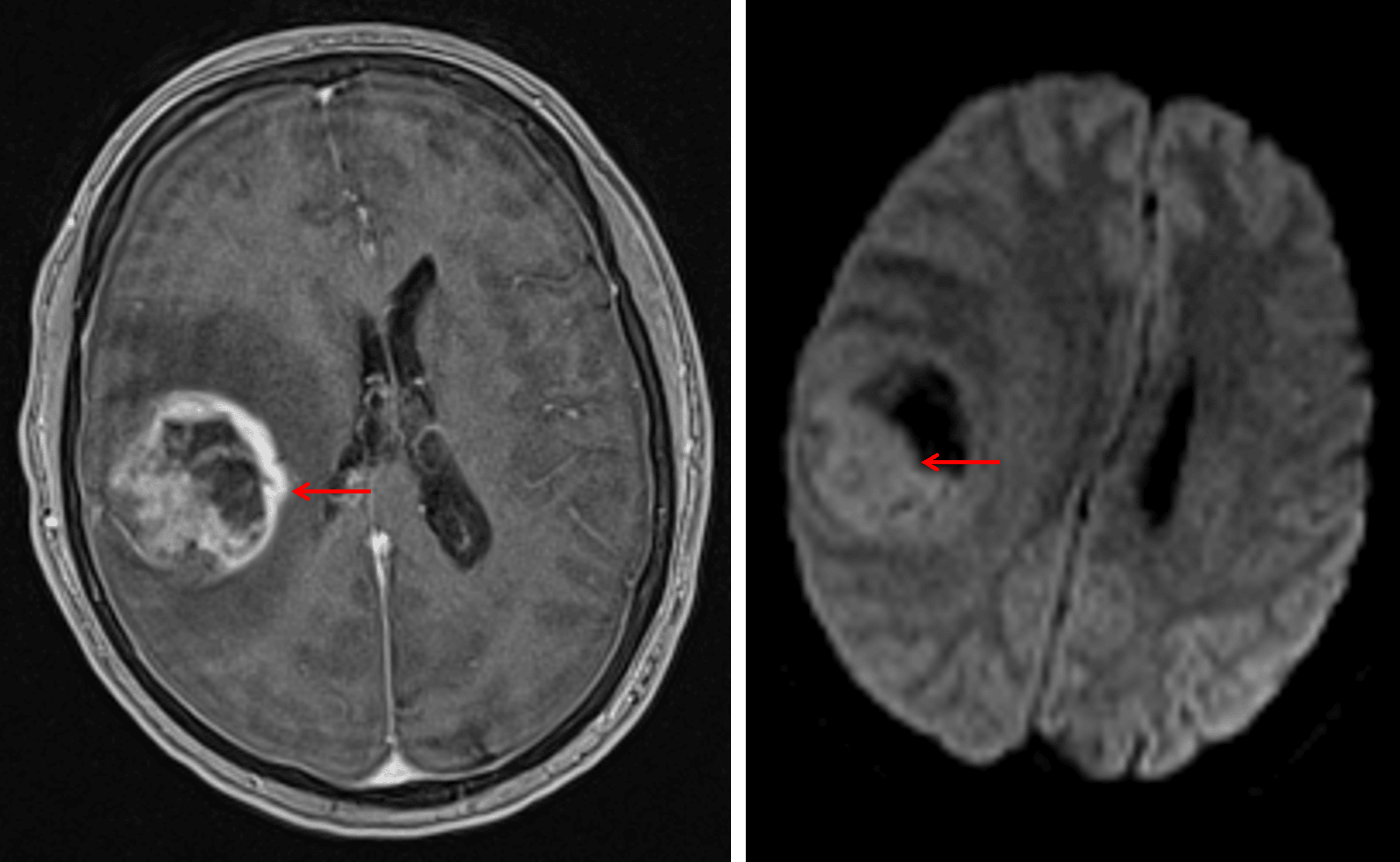 Heterogeneously enhancing mass with reduced diffusivity corresponding with the enhancing components (red arrows), most suspicious for a high-grade glial neoplasm.