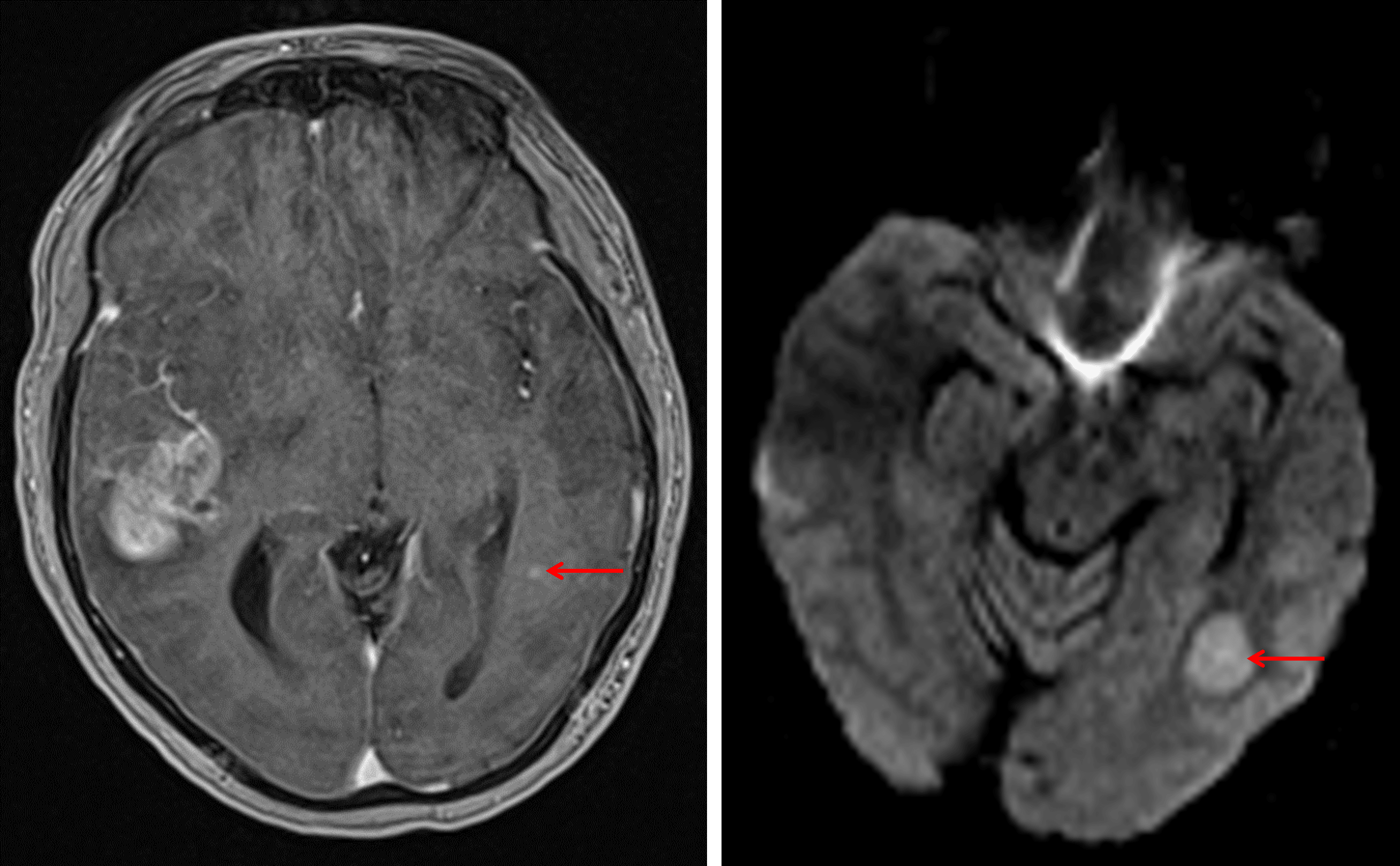 Additional masslike area of restricted diffusion in the posterior left temporal lobe with a nodular focus of enhancement along its anterior margin (red arrows).