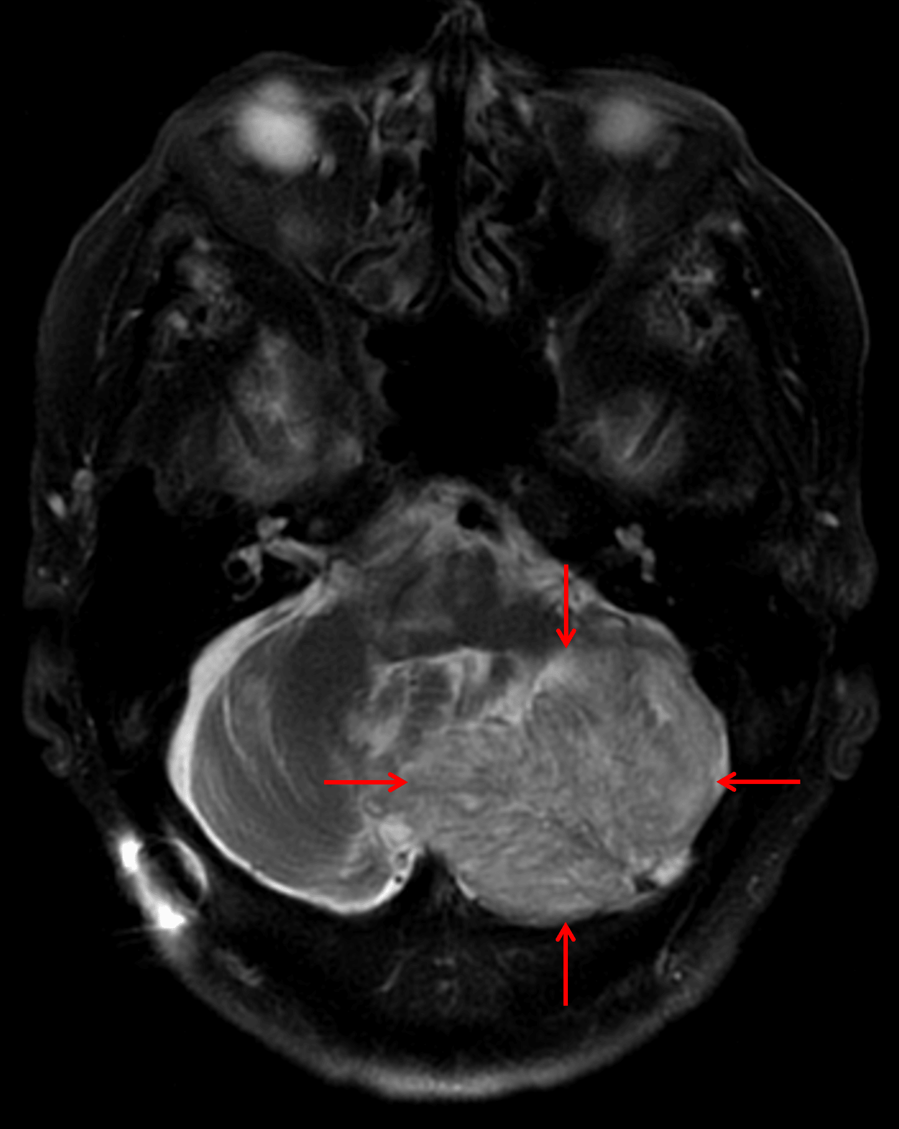 Mildly T2 hyperintense left cerebellar mass with striated internal architecture (red arrows), which is a classic appearance for a dysplastic cerebellar gangliocytoma.