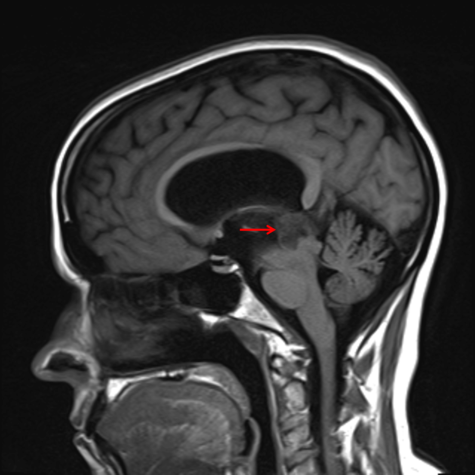 T1 hypointense pineal region mass (red arrow) with downward mass effect on the tectum and associated obstructive hydrocephalus.