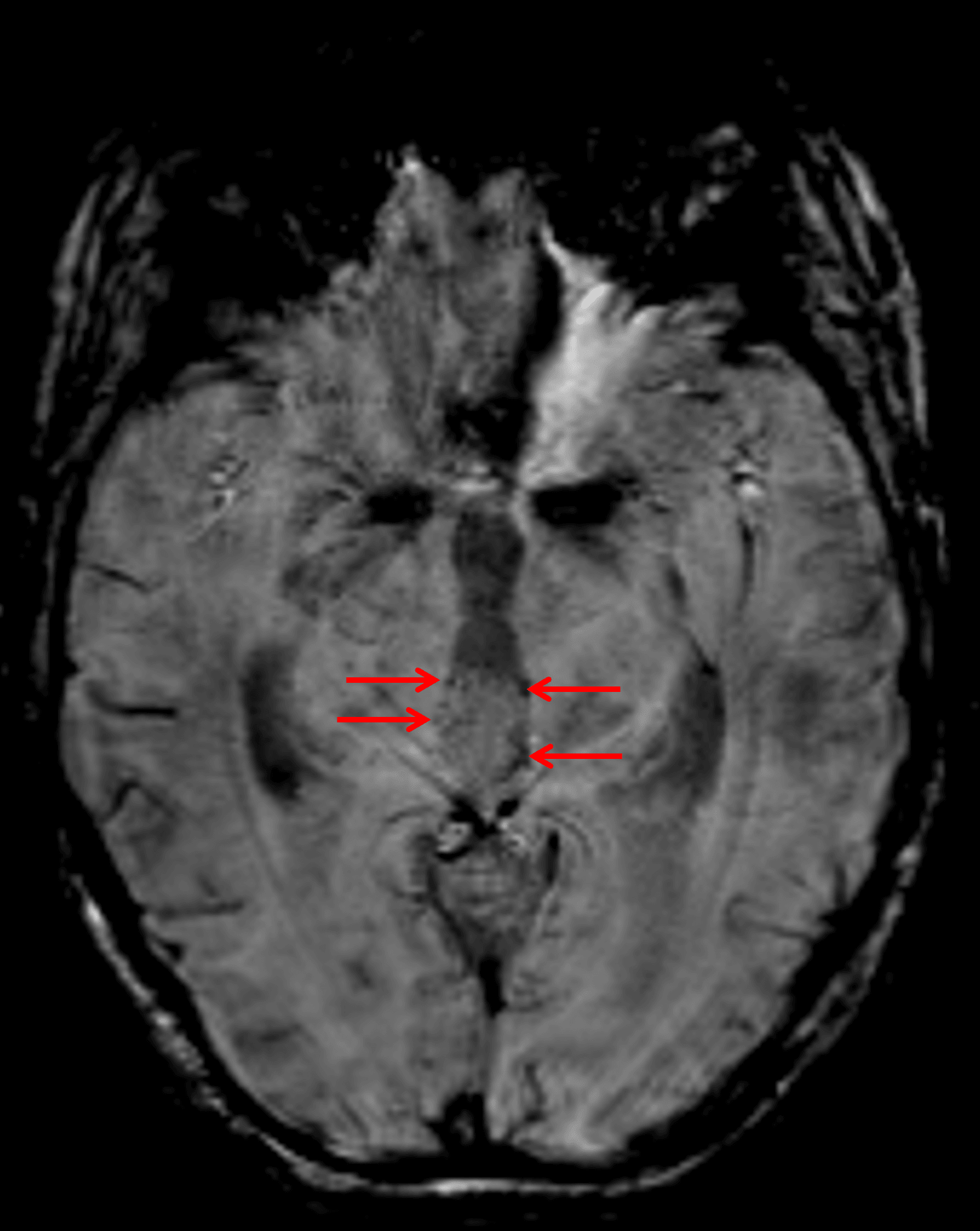 Foci of susceptibility artifact along the periphery of the mass (red arrows) represent peripheral calcification.