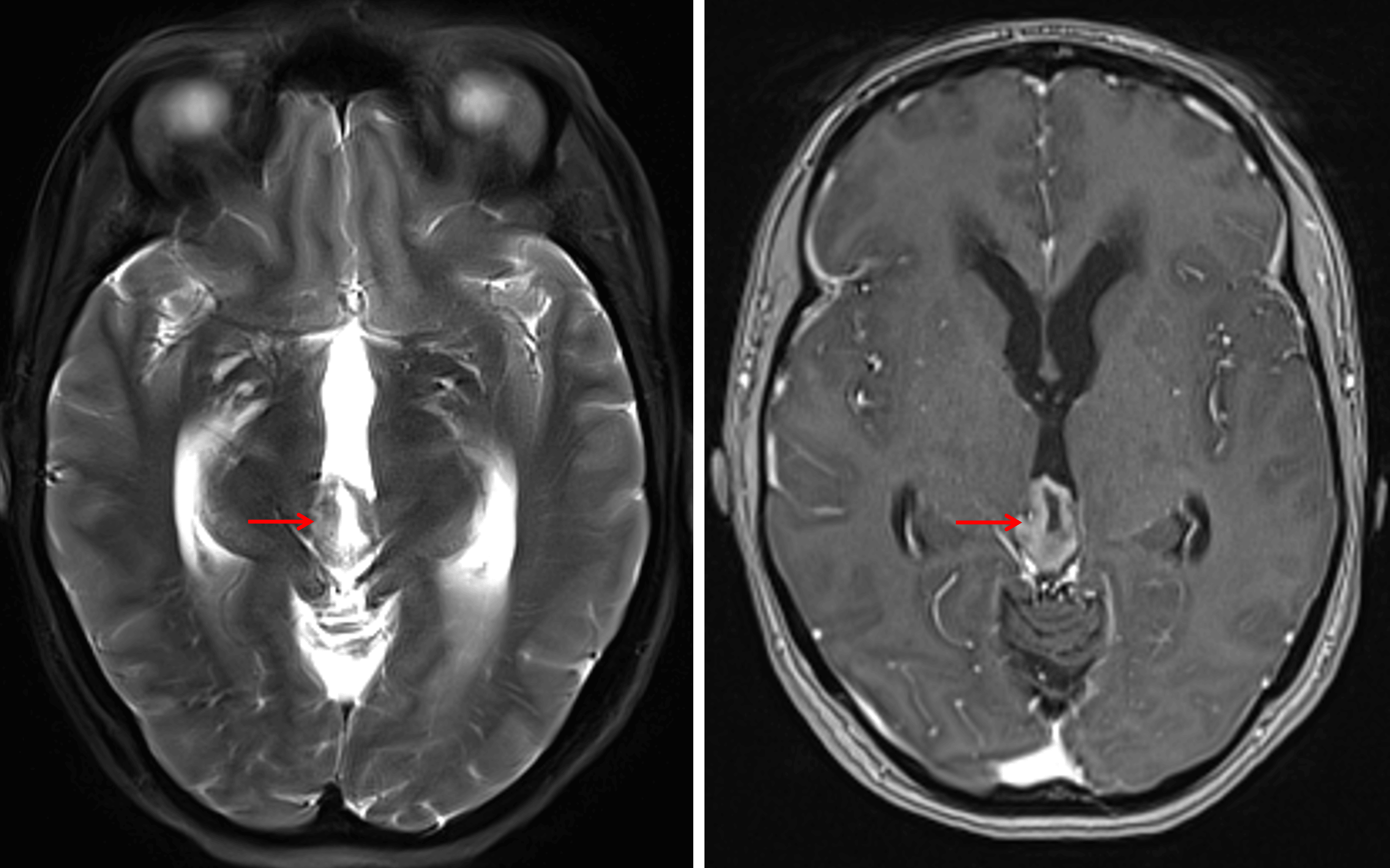 The mass has an internal cystic component with avid enhancement of the solid components (red arrows).