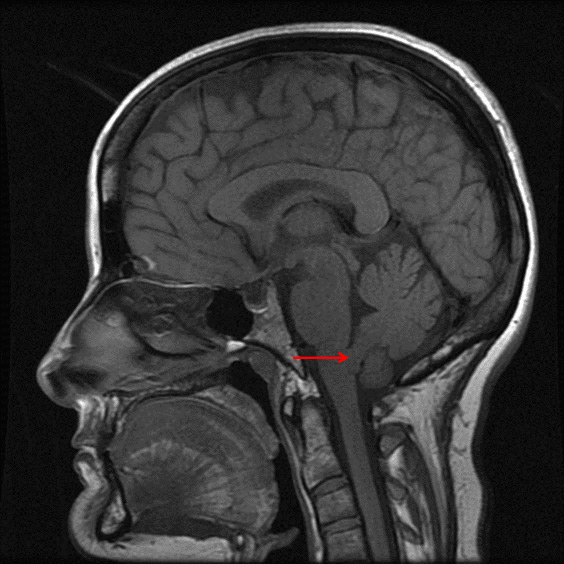 T1 isointense mass in the inferior aspect of the fourth ventricle (red arrow).