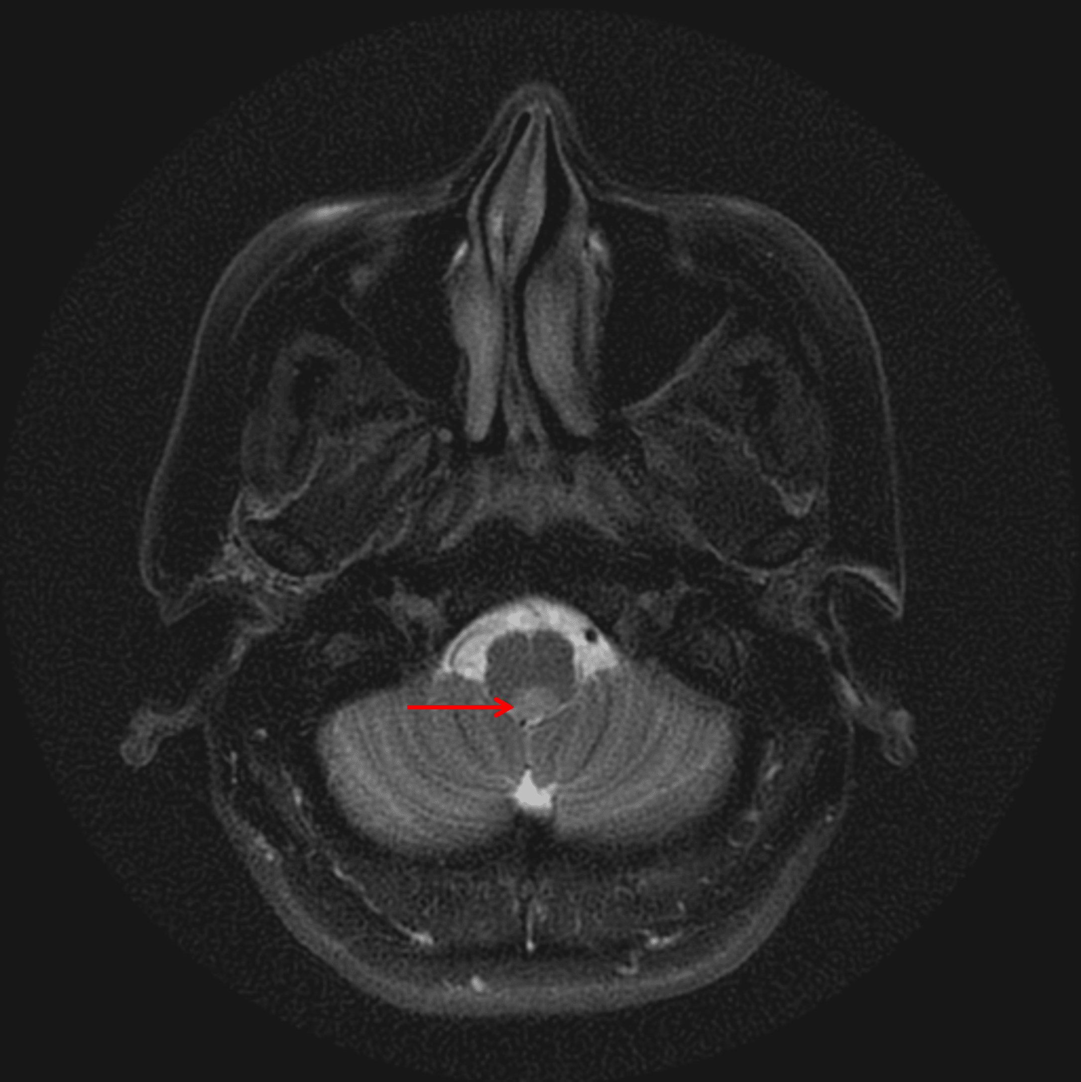 Mild corresponding T2 signal hyperintensity (red arrow).