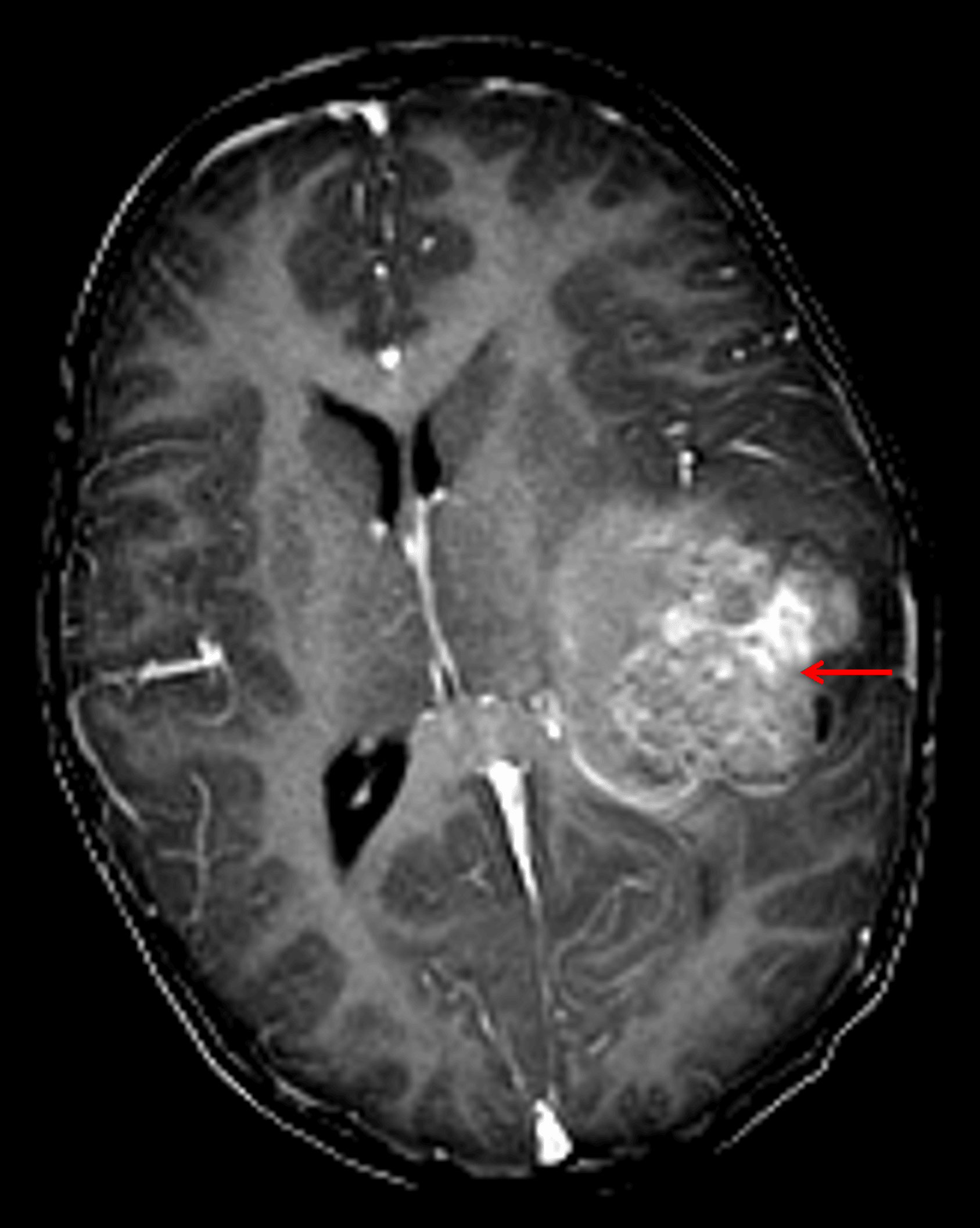 Heterogeneously enhancing mass in the left cerebral hemisphere (red arrow) with associated local mass effect and midline shift.