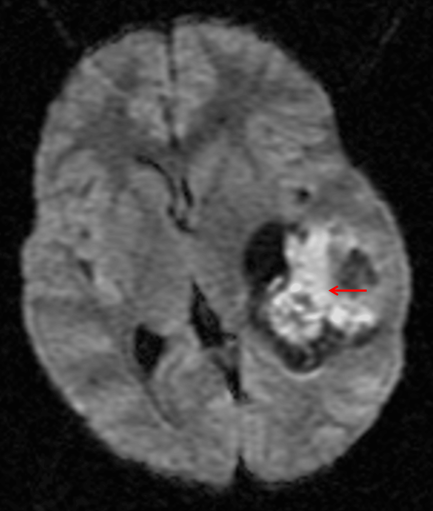 Areas of internal restricted diffusion (red arrow) corresponding with the enhancing components, indicative of hypercellularity.
