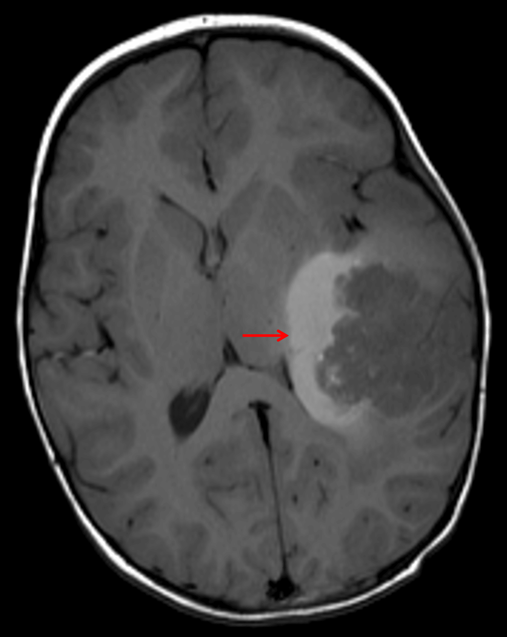 Area of T1 signal hyperintensity along the deep margin of the tumor (red arrow), likely representing tumor-related hemorrhage.