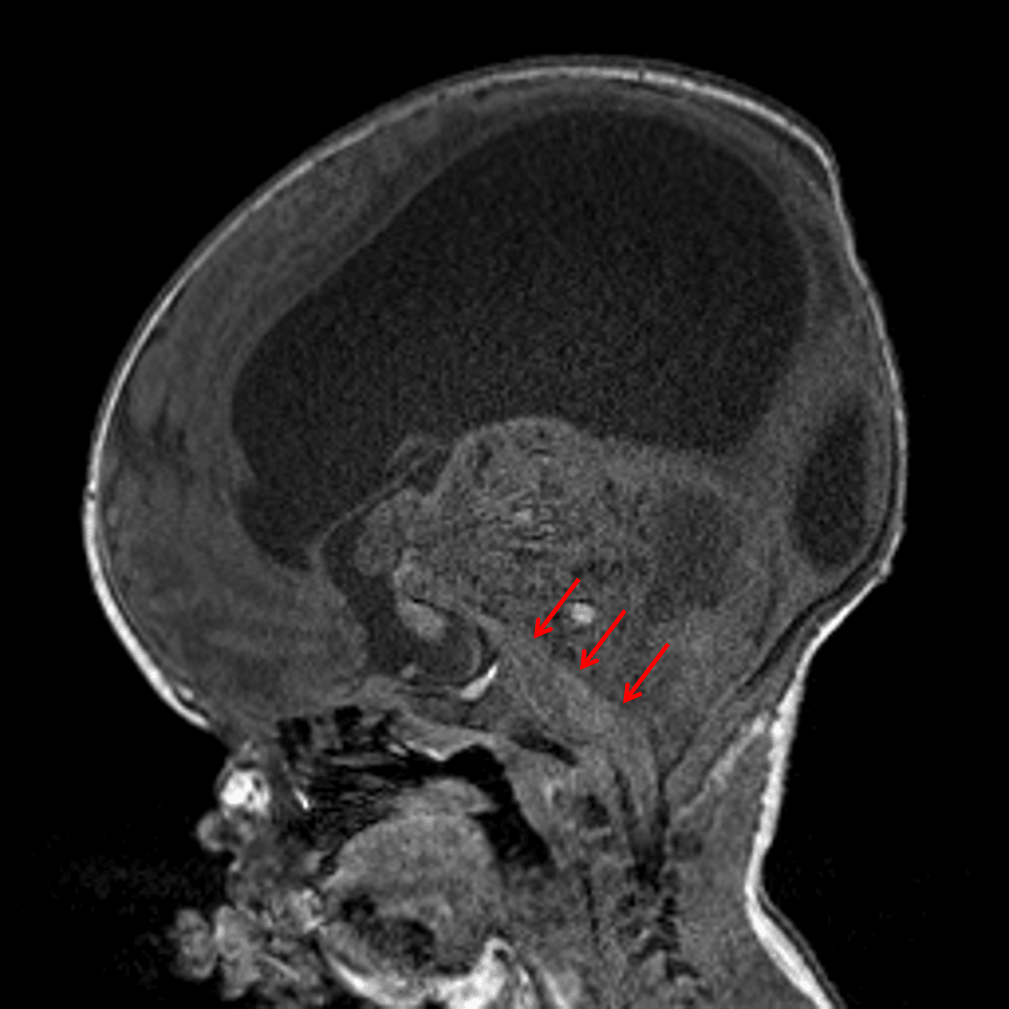 Large mass centered in the superior aspect of the posterior fossa with anterior displacement of and severe mass effect on the brainstem (red arrows).