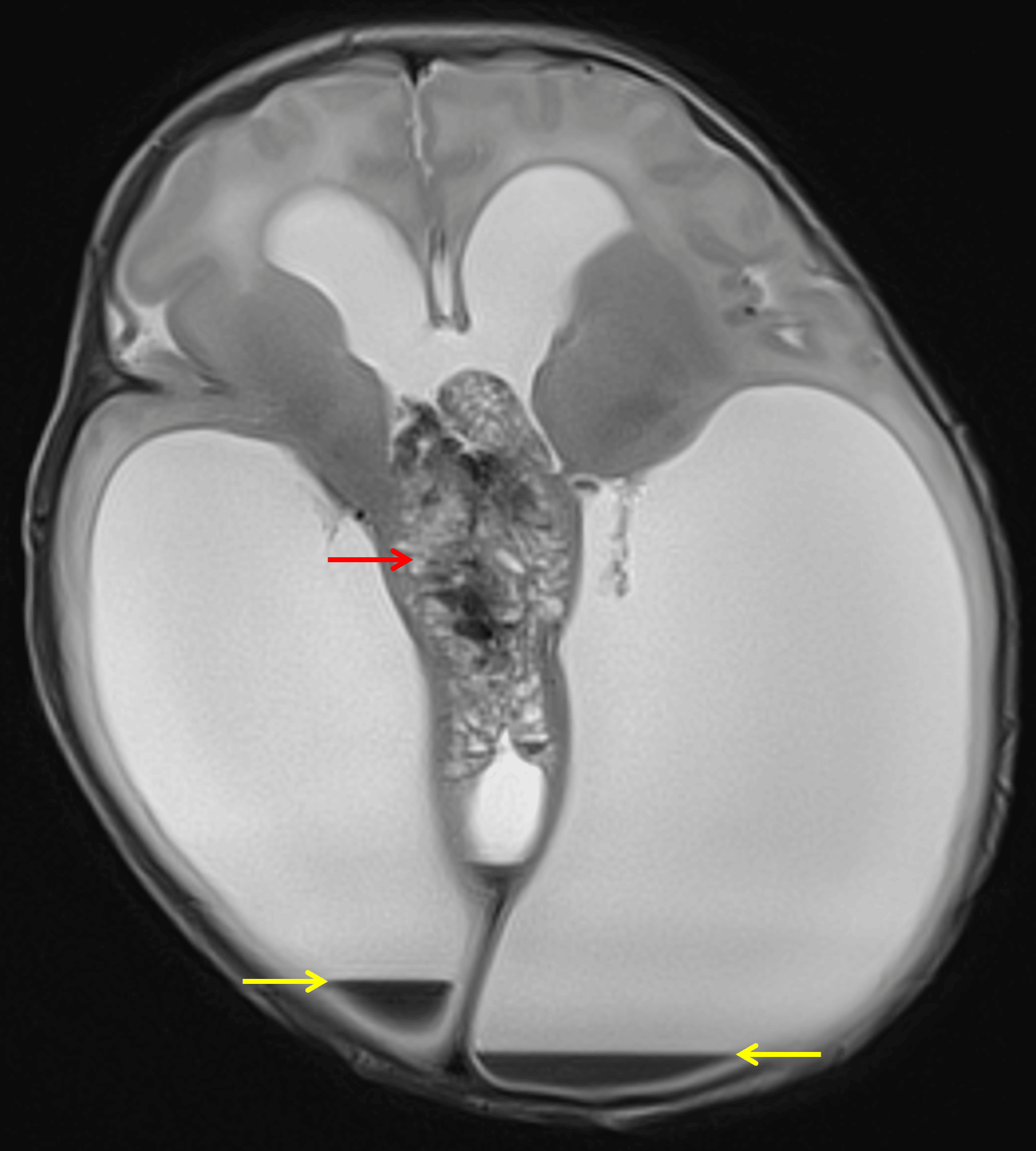Heterogeneous midline mass (red arrow) with associated severe obstructive hydrocephalus and small volume intraventricular hemorrhage (yellow arrows).
