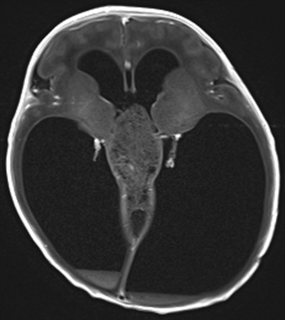 This mass demonstrates no appreciable corresponding enhancement.