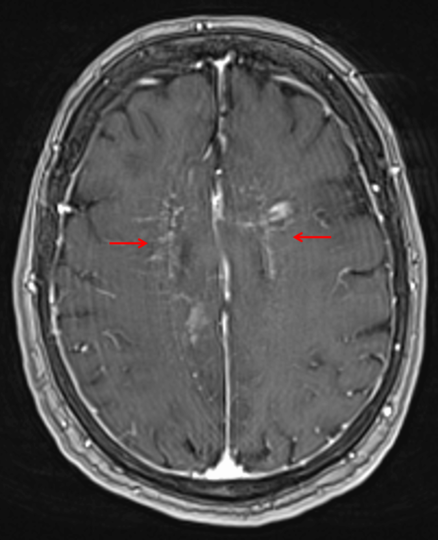 Curvilinear and nodular enhancement tracking along perivascular spaces in the bilateral cerebral white matter (red arrows) in this patient with intravascular lymphoma.