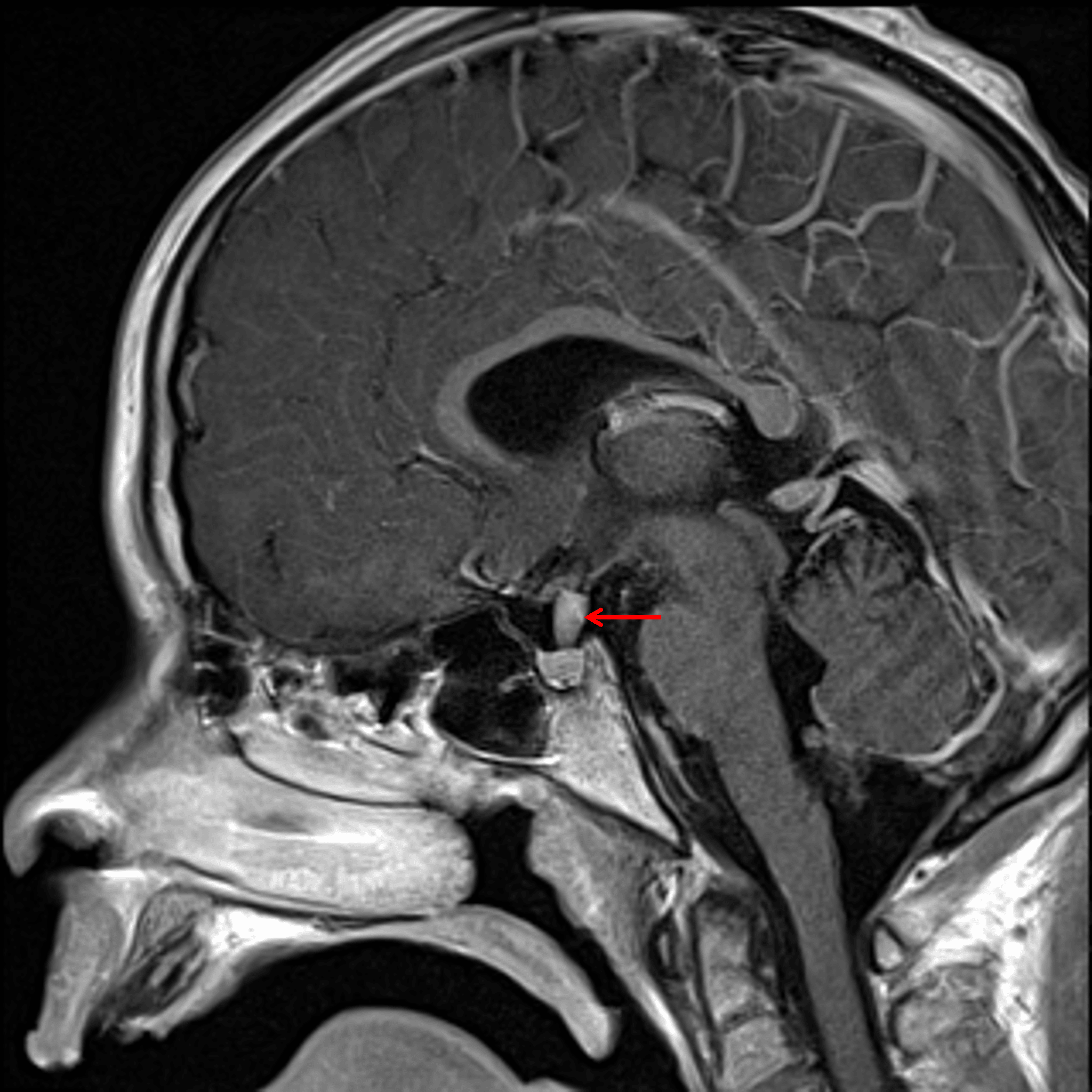 Diffuse enhancement of the pituitary stalk lesion (red arrow).