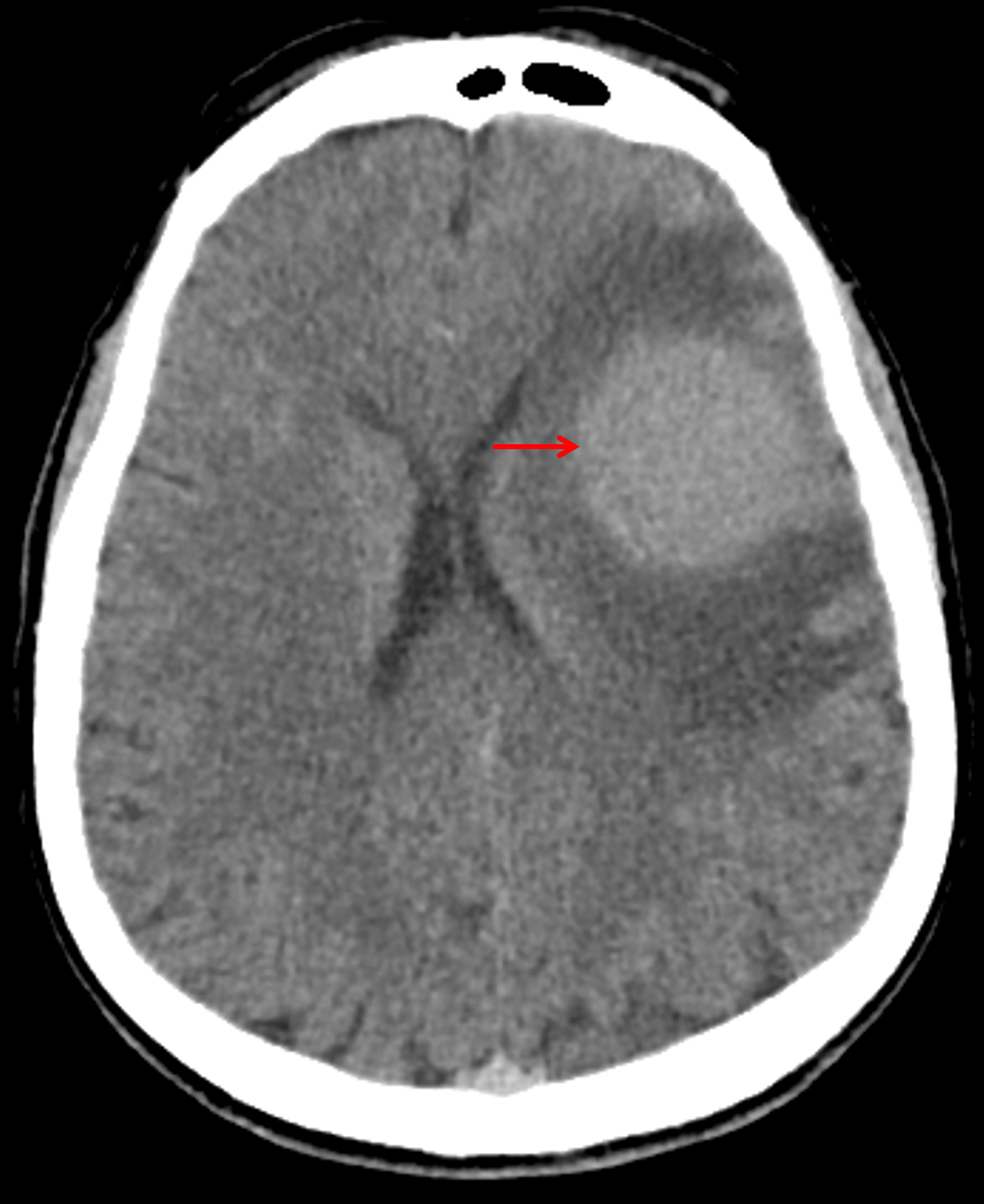 Hyperattenuating mass on CT (red arrow) with surrounding vasogenic edema.