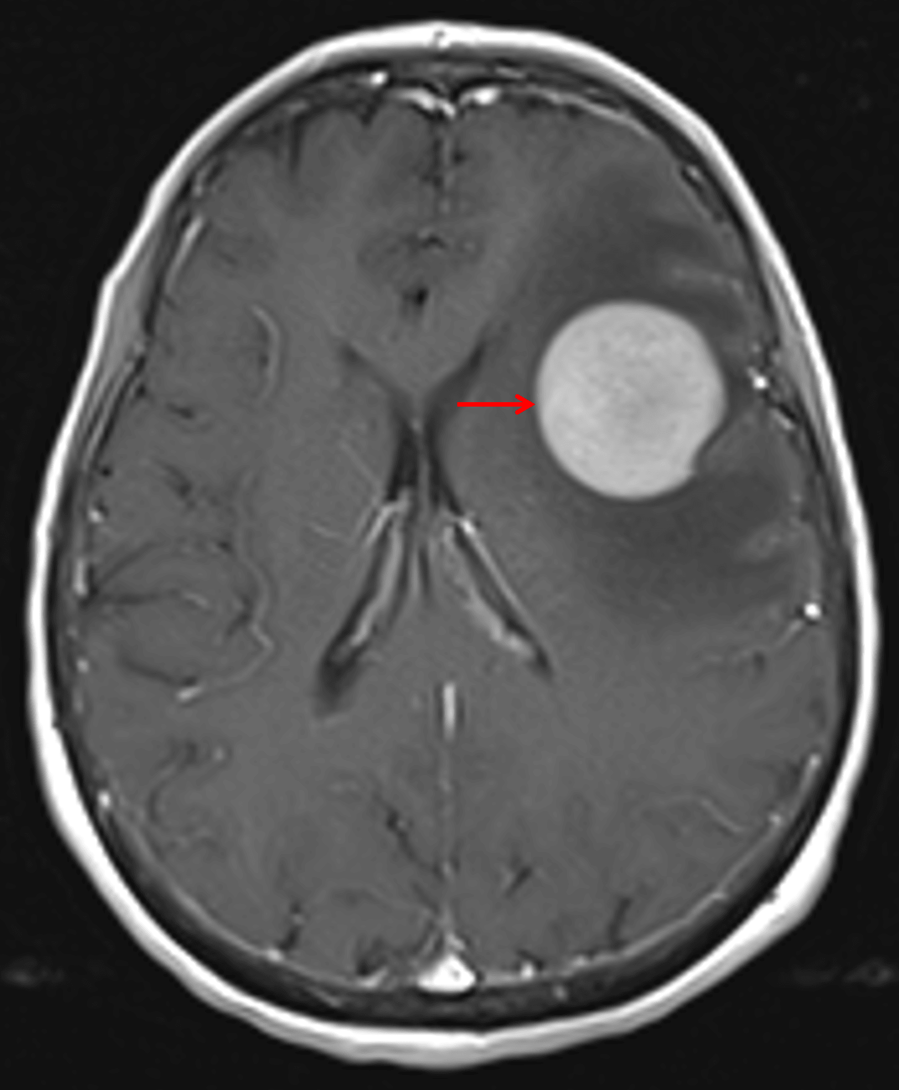 Avid, diffuse corresponding enhancement (red arrow).