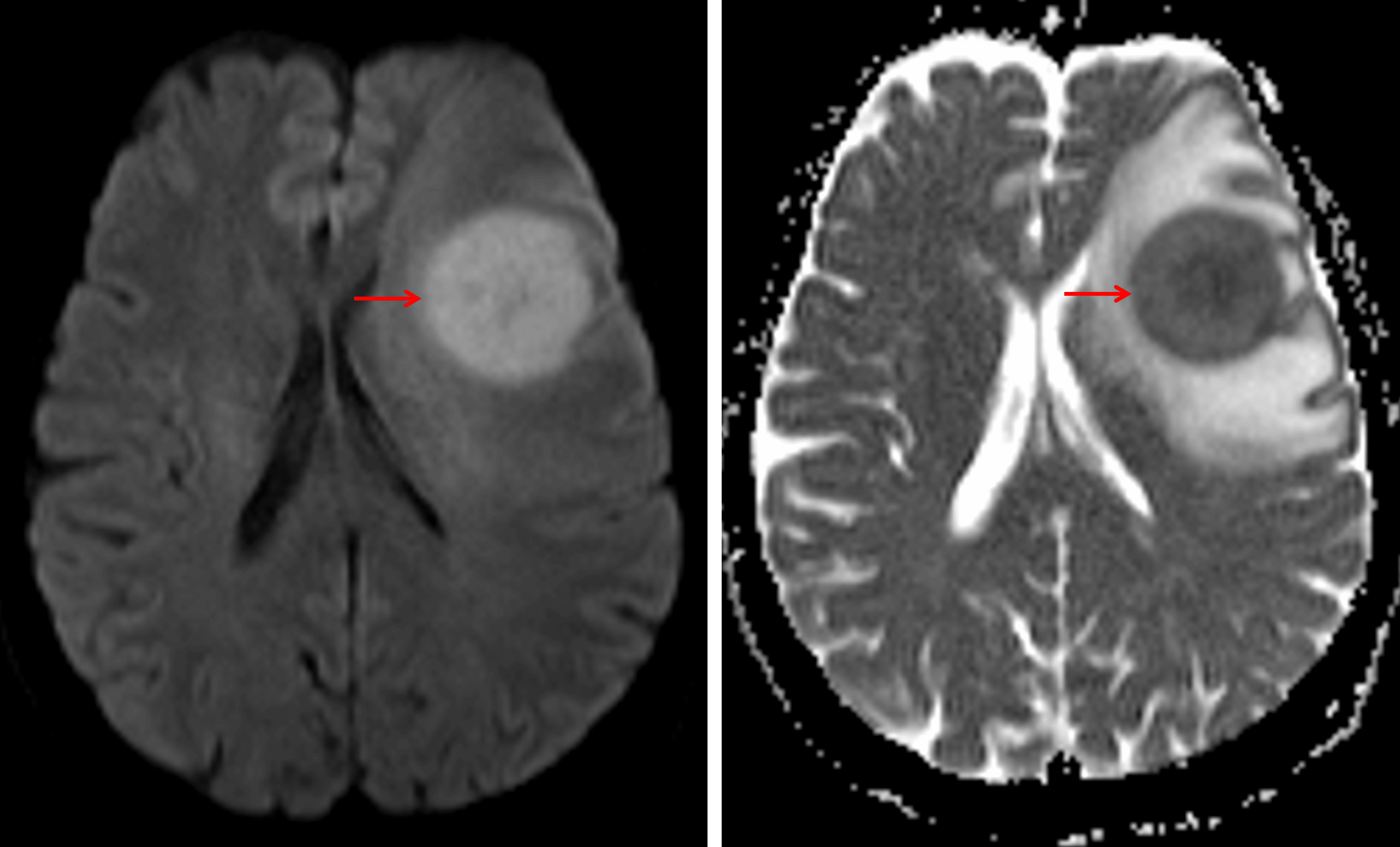 Corresponding diffuse restricted diffusion (red arrows).