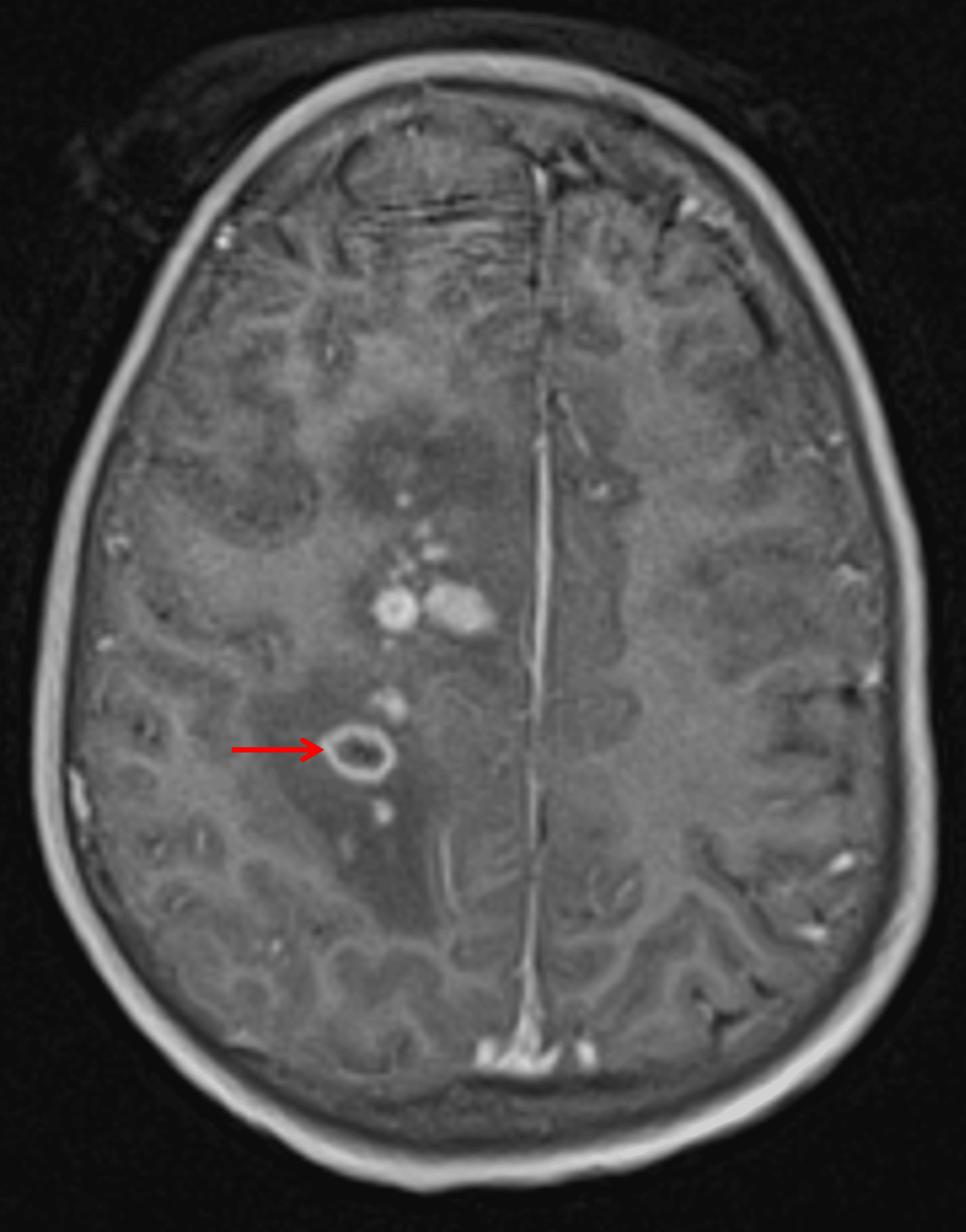 Numerous small enhancing lesions are seen. Most solidly enhance, but one in this image demonstrates peripheral enhancement (red arrow).