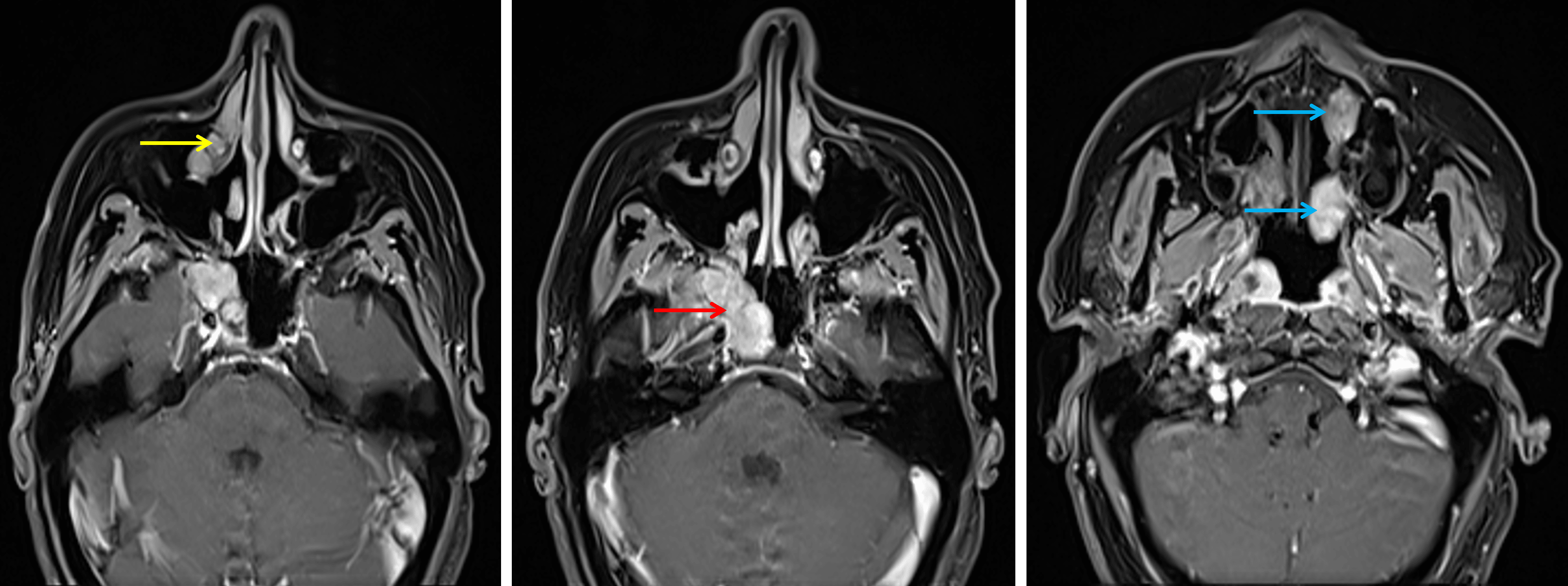 Multiple enhancing mass involving the right skull base (red arrow), right nasolacrimal duct (yellow arrow), and left nasal cavity (blue arrows).