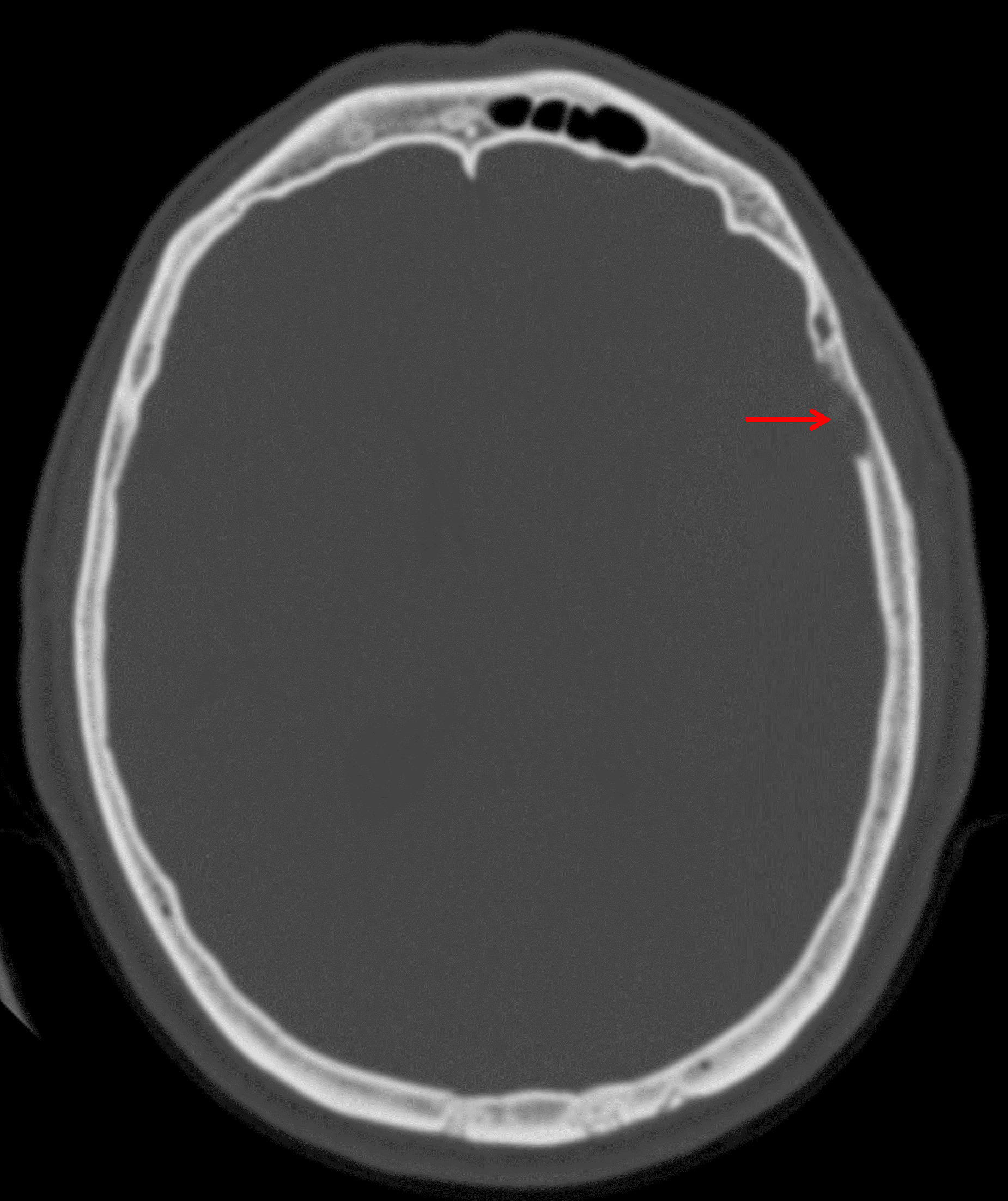 Inner table calvarial erosion overlying the mass (red arrow).
