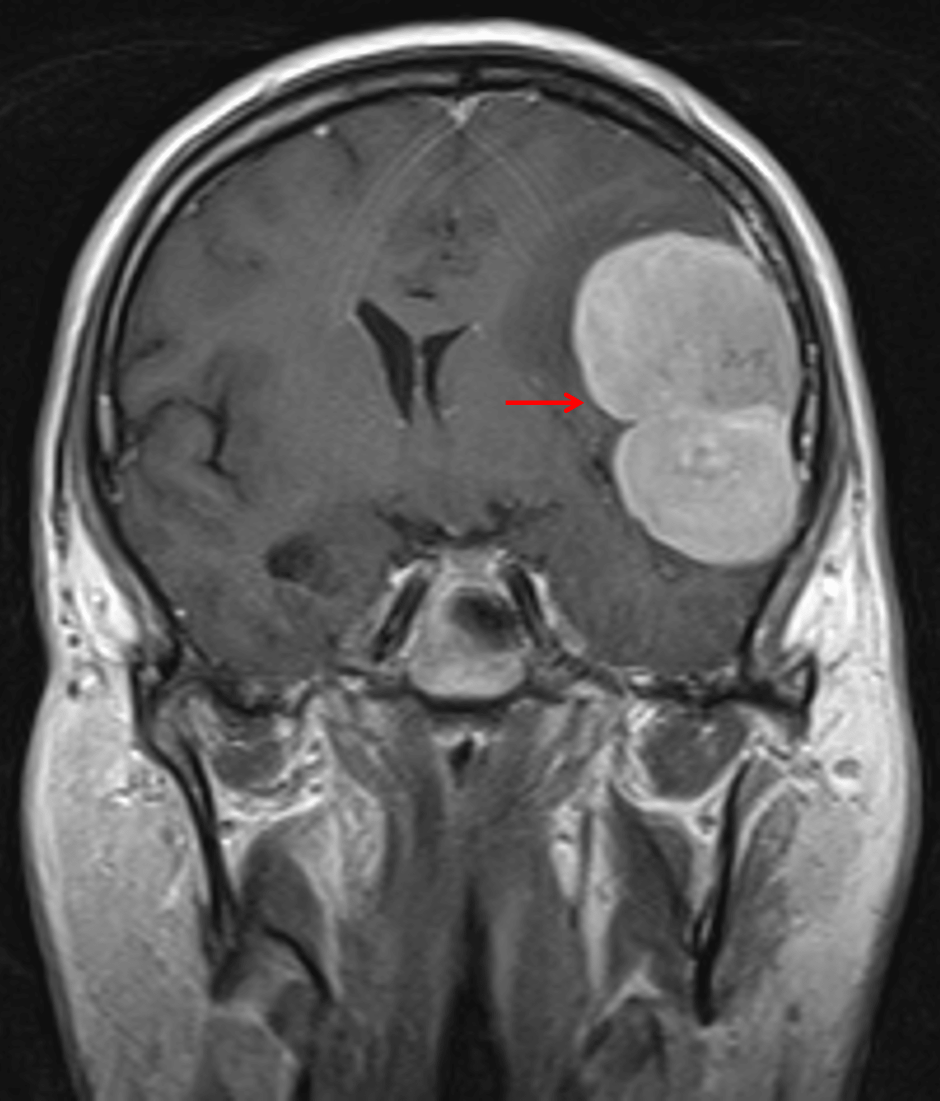 Avidly enhancing mass with lobulated contours (red arrow).