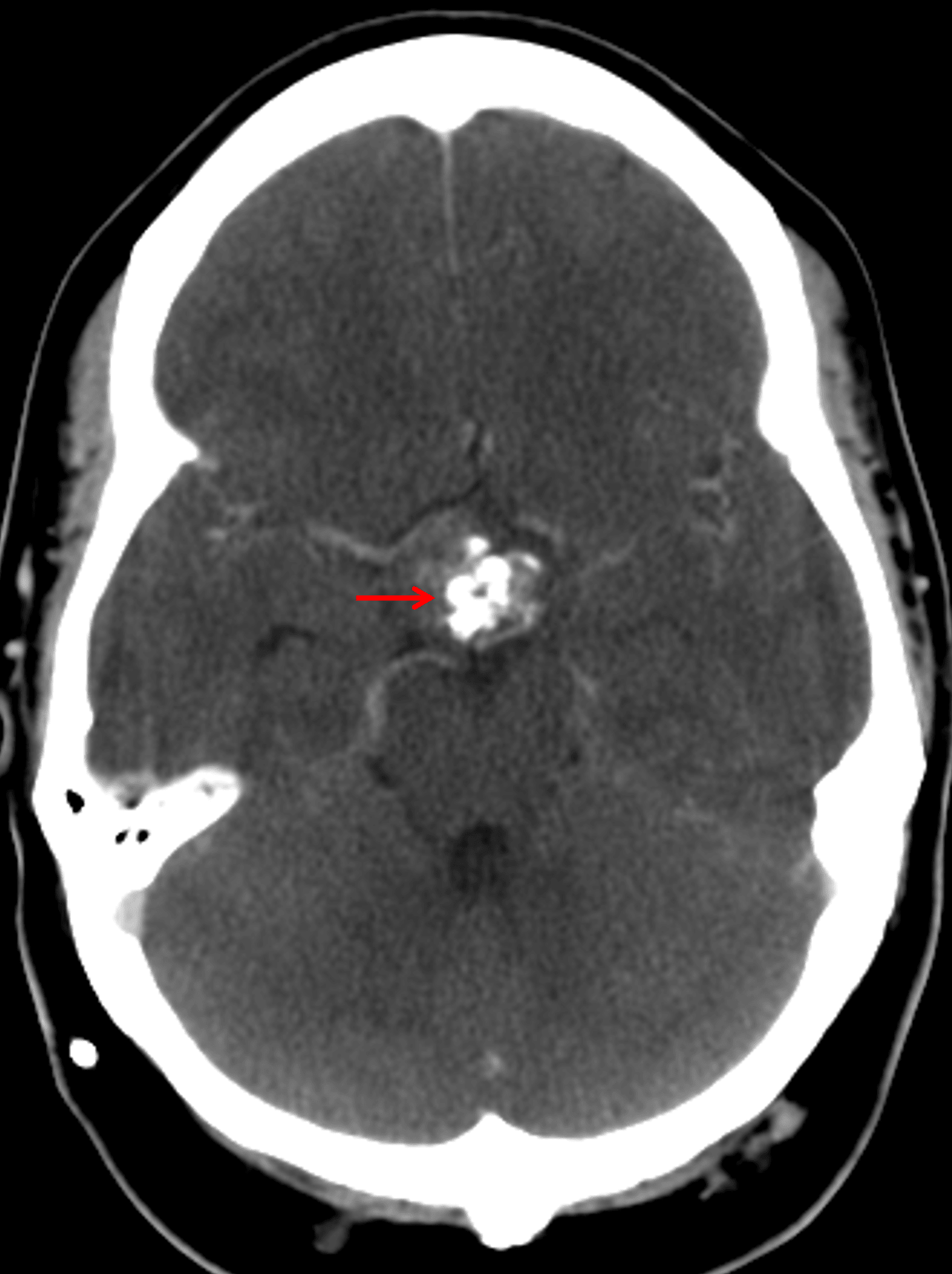 Suprasellar mass with coarse internal calcification (red arrow).