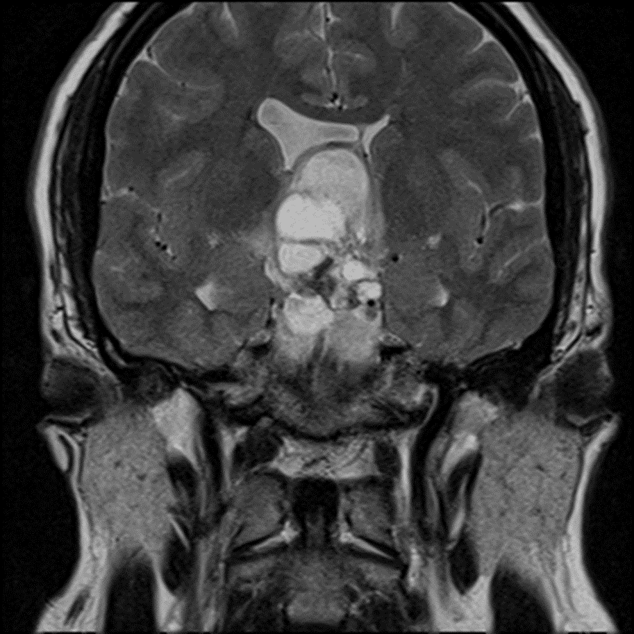 Multiple T2 hyperintense cystic components.