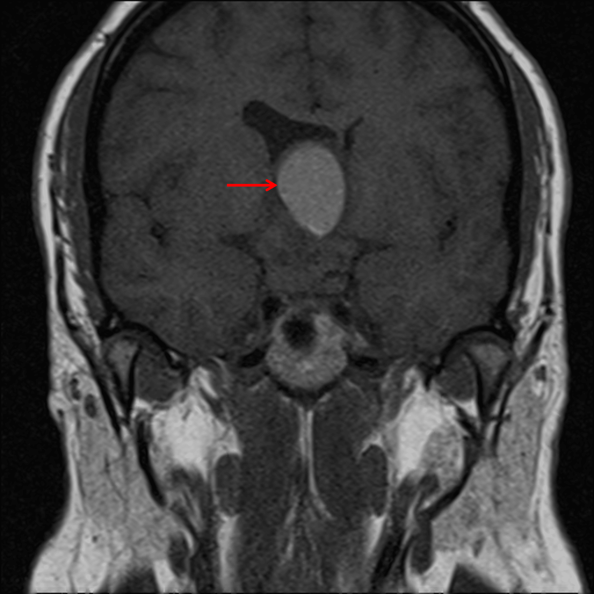 Intrinsic T1 signal hyperintensity within one of the larger superior cysts (red arrow).