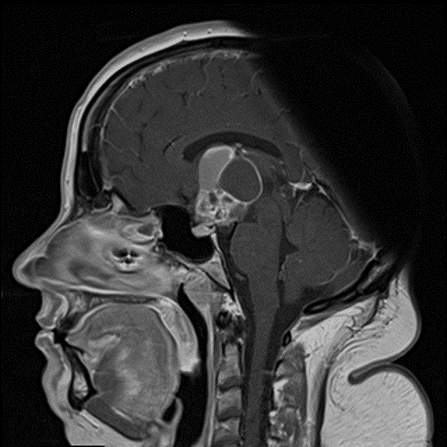 Solid enhancement of the solid components and peripheral enhancement of the cystic components.