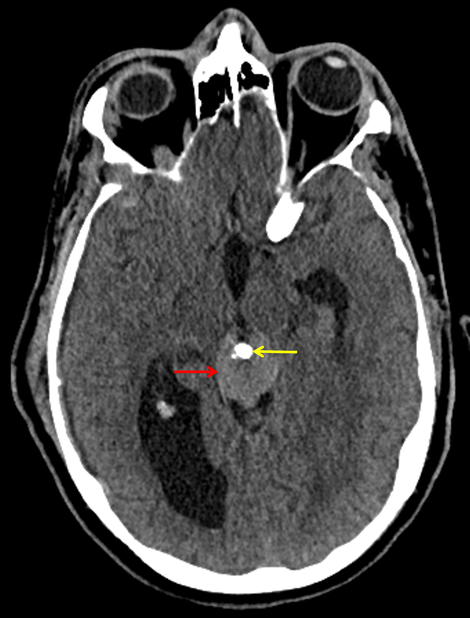 Mildly hyperattenuating pineal region mass (red arrow) which engulfs the pineal calcification (yellow arrow).