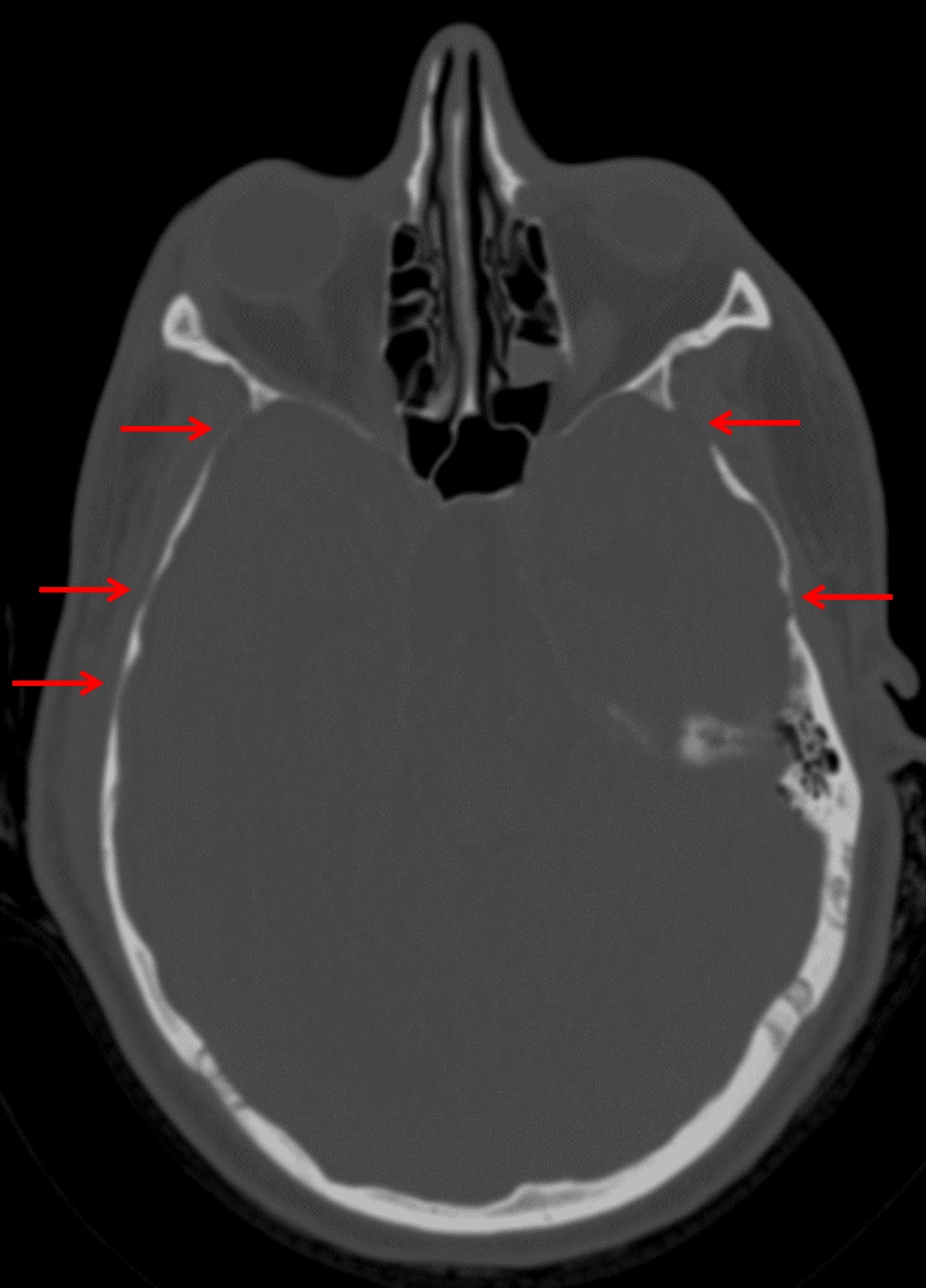 Multiple areas of calvarial thinning (red arrows), likely the result of longstanding elevated intracranial pressure.