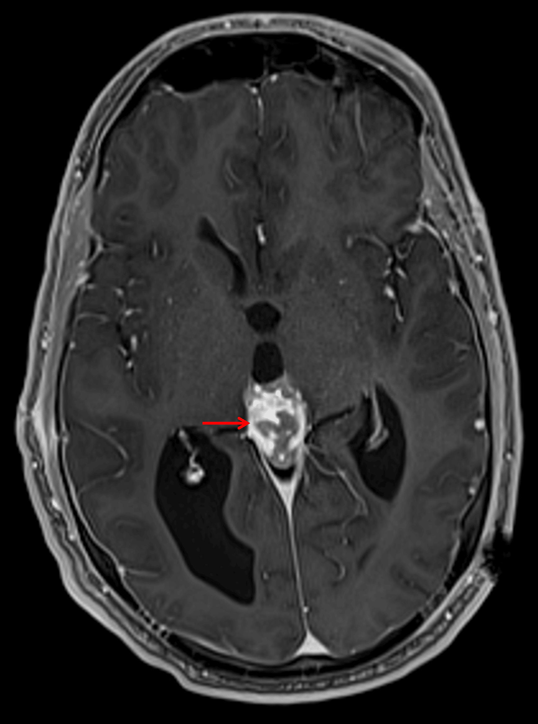 Corresponding avid but heterogeneous enhancement (red arrow).