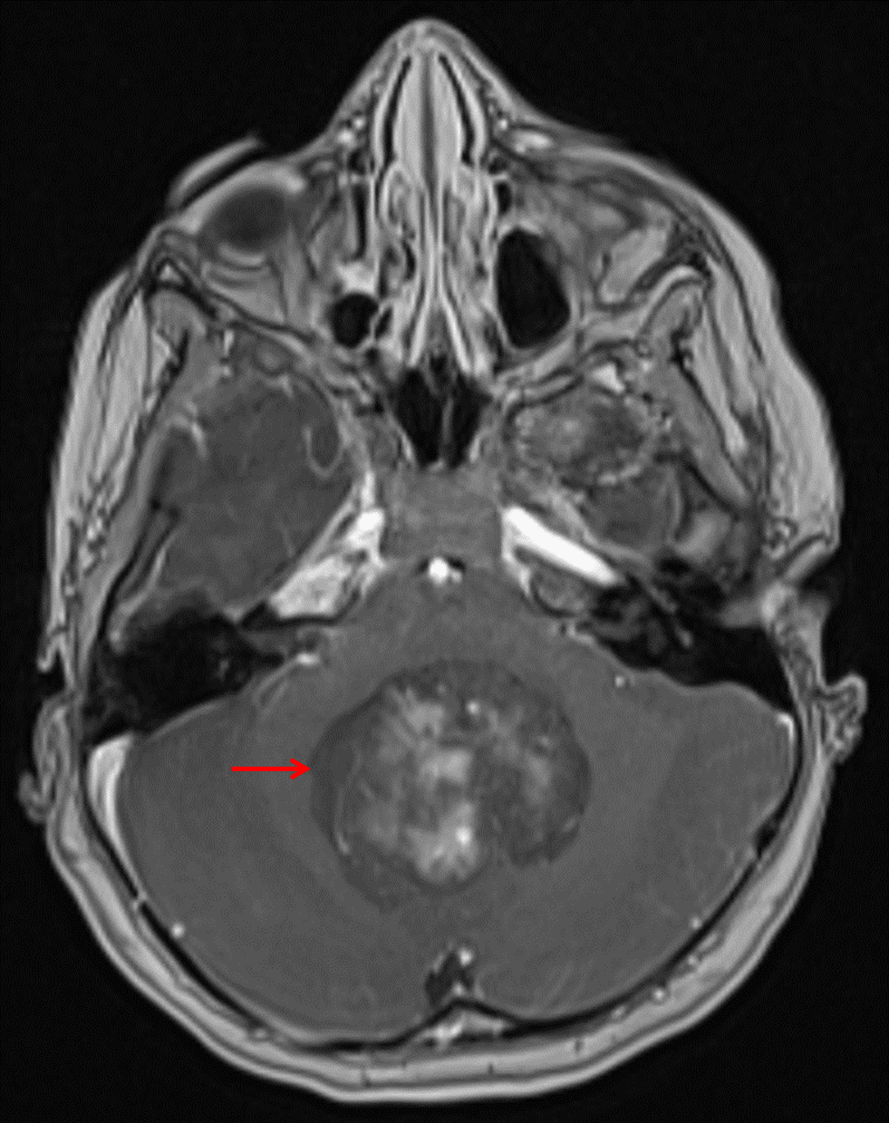 Heterogeneously enhancing mass centered in the vermis and fourth ventricle (red arrow).