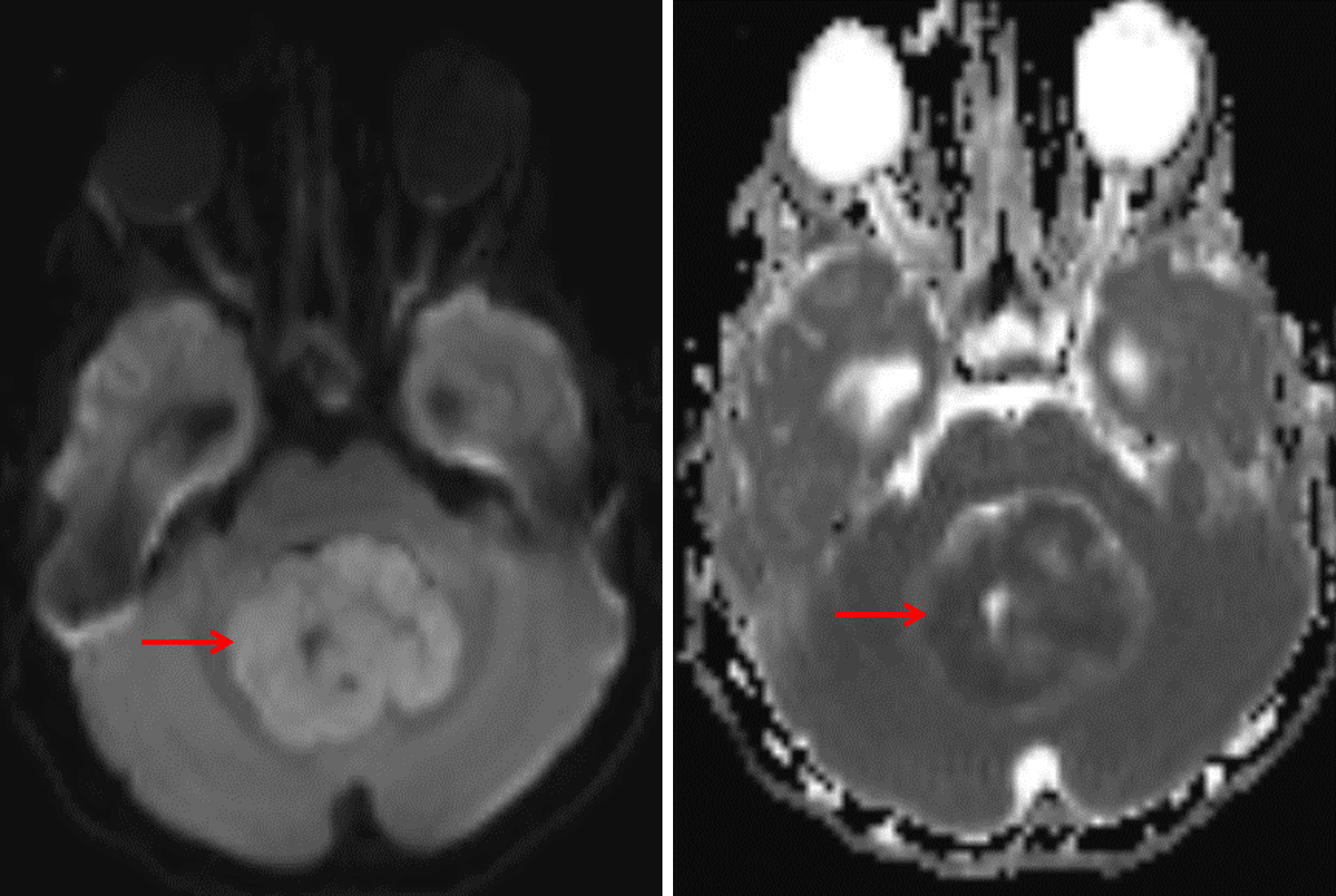 The tumor demonstrates diffuse corresponding restricted diffusion (red arrows), meaning hyperintense signal on the diffusion sequence (left) and hypointense signal on the ADC map (right).